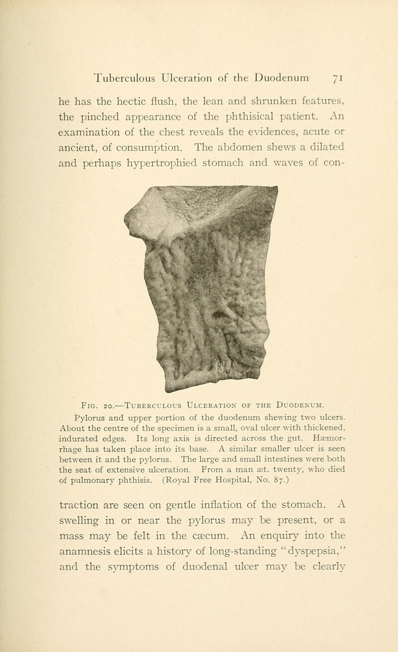 he has the hectic flush, the lean and shrunken features, the pinched appearance of the phthisical patient. An examination of the chest reveals the evidences, acute or ancient, of consumption. The abdomen shews a dilated and perhaps hypertrophied stomach and waves of con- Fig. 20.—Tuberculous Ulceration of the Duodenum. Pylorus and upper portion of the duodenum shewing two ulcers. About the centre of the specimen is a small, oval ulcer with thickened, indurated edges. Its long axis is directed across the gut. Haemor- rhage has taken place into its base. A similar smaller ulcer is seen between it and the pylorus. The large and small intestines were both the seat of extensive ulceration. From a man aet. twenty, who died of pulmonary phthisis. (Royal Free Hospital, No. 87.) traction are seen on gentle inflation of the stomach. A swelling in or near the pylorus may be present, or a mass may be felt in the caecum. An enquiry into the anamnesis elicits a history of long-standing dyspepsia, and the symptoms of duodenal ulcer may be clearly