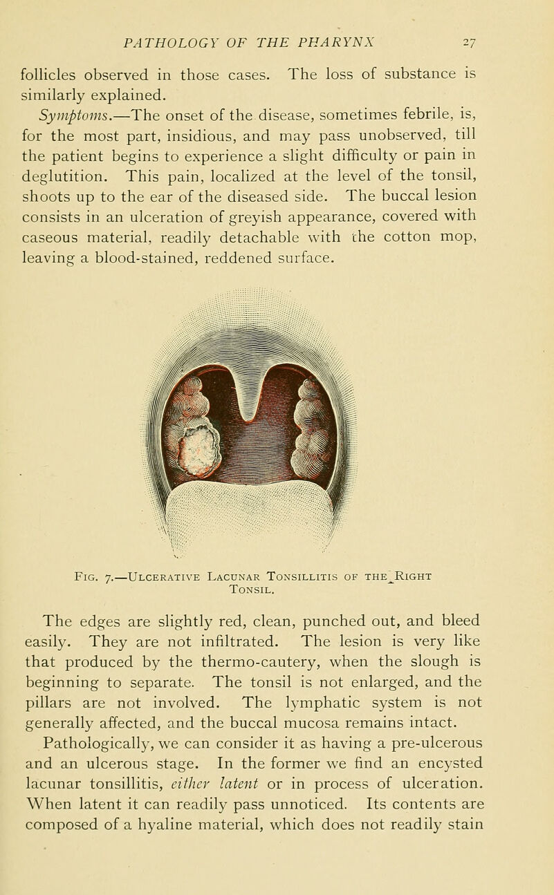 follicles observed in those cases. The loss of substance is similarly explained. Symptoms.—The onset of the disease, sometimes febrile, is, for the most part, insidious, and may pass unobserved, till the patient begins to experience a slight difficulty or pain in deglutition. This pain, localized at the level of the tonsil, shoots up to the ear of the diseased side. The buccal lesion consists in an ulceration of greyish appearance, covered with caseous material, readily detachable with the cotton mop, leaving a blood-stained, reddened surface. Fig. 7.—Ulcerative Lacunar Tonsillitis of the^Right Tonsil. The edges are slightly red, clean, punched out, and bleed easily. They are not infiltrated. The lesion is very like that produced by the thermo-cautery, when the slough is beginning to separate. The tonsil is not enlarged, and the pillars are not involved. The lymphatic system is not generally affected, and the buccal mucosa remains intact. Pathologically, we can consider it as having a pre-ulcerous and an ulcerous stage. In the former we find an encysted lacunar tonsillitis, either latent or in process of ulceration. When latent it can readily pass unnoticed. Its contents are composed of a hyaline material, which does not readily stain