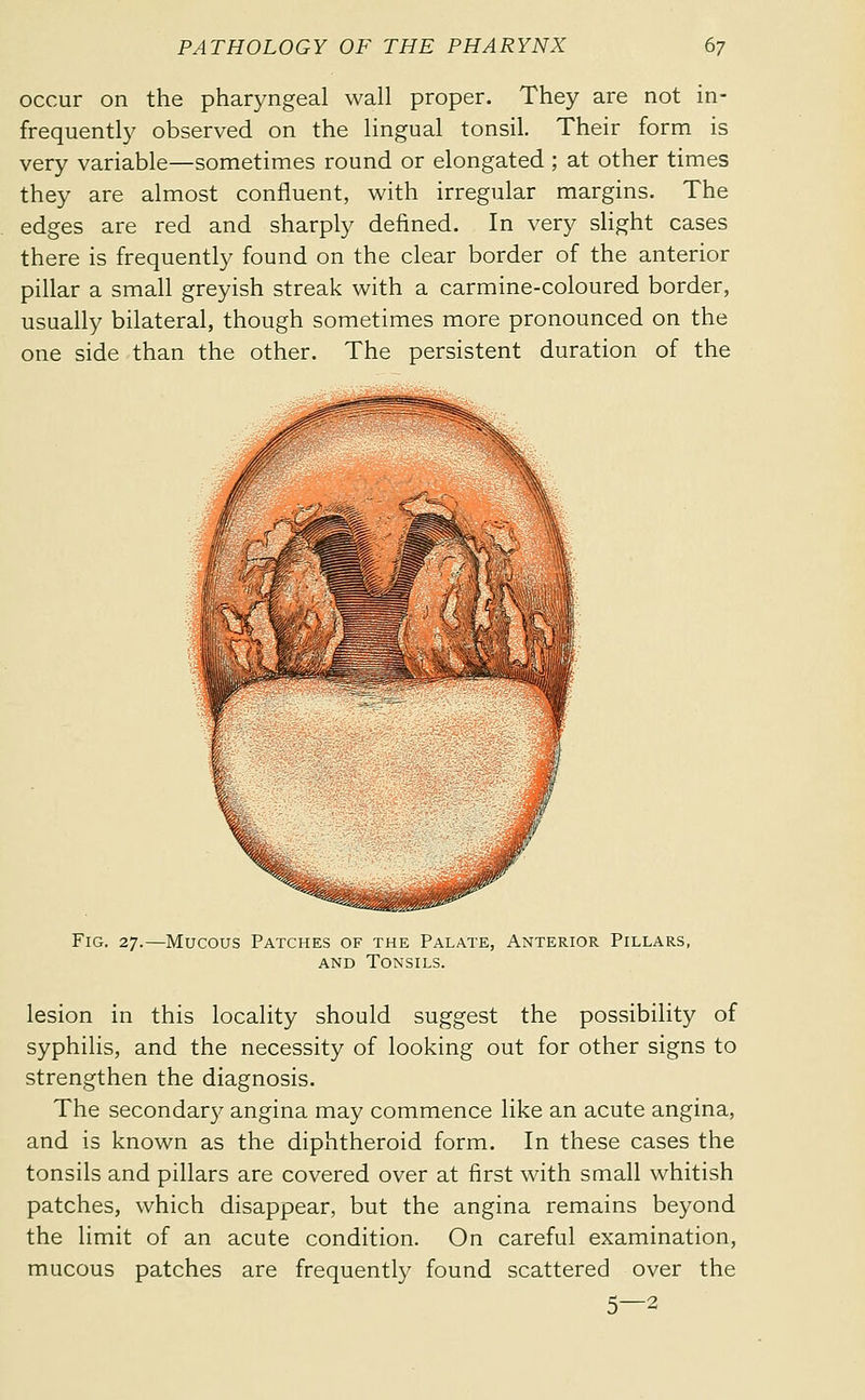 occur on the pharyngeal wall proper. They are not in- frequently observed on the lingual tonsil. Their form is very variable—sometimes round or elongated ; at other times they are almost confluent, with irregular margins. The edges are red and sharply defined. In very slight cases there is frequently found on the clear border of the anterior pillar a small greyish streak with a carmine-coloured border, usually bilateral, though sometimes more pronounced on the one side than the other. The persistent duration of the Fig. 27.—Mucous Patches of the Palate, Anterior Pillars, AND Tonsils. lesion in this locality should suggest the possibility of syphilis, and the necessity of looking out for other signs to strengthen the diagnosis. The secondar}^ angina may commence like an acute angina, and is known as the diphtheroid form. In these cases the tonsils and pillars are covered over at first with small whitish patches, which disappear, but the angina remains beyond the limit of an acute condition. On careful examination, mucous patches are frequently found scattered over the 5—2