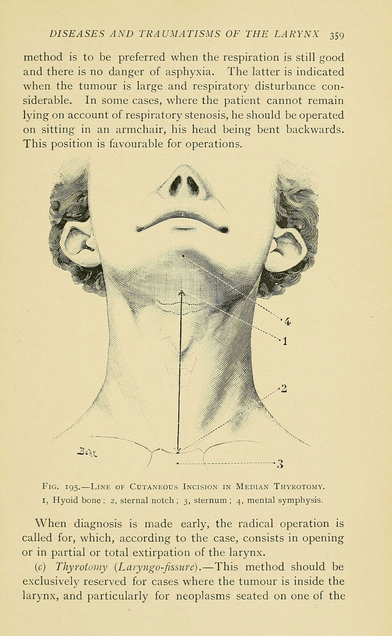 method is to be preferred when the respiration is still good and there is no danger of asphyxia. The latter is indicated when the tumour is large and respiratory disturbance con- siderable. In some cases, where the patient cannot remain lying on account of respiratory stenosis, he should be operated on sitting in an armchair, his head being bent backwards. This position is favourable for operations. 3c\^ Fig. 195.—Line of Cutaneous Incision in Median Thyrotomy. I, Hyoid bone ; 2, sternal notch ; 3, sternum ; 4, mental symphysis. When diagnosis is made early, the radical operation is called for, which, according to the case, consists in opening or in partial or total extirpation of the larynx. (c) Thyrotuuiy {Lavyngu-fissuré).—This method should be exclusively reserved for cases where the tumour is inside the larynx, and particularly for neoplasms seated on one of the