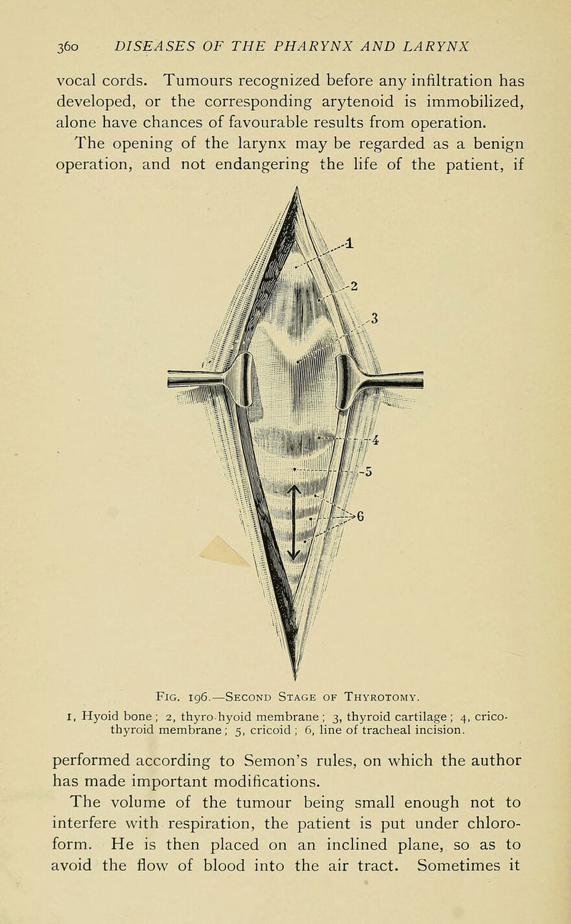 vocal cords. Tumours recognized before any infiltration has developed, or the corresponding arytenoid is immobilized, alone have chances of favourable results from operation. The opening of the larynx may be regarded as a benign operation, and not endangering the life of the patient, if Fig. 196.—Second Stage of Thyrotomy. I, Hyoid bone; 2, thyro-hyoid membrane; 3, thyroid cartilage; 4, crico- thyroid membrane; 5, cricoid ; 6, line of tracheal incision. performed according to Semon's rules, on which the author has made important modifications. The volume of the tumour being small enough not to interfere with respiration, the patient is put under chloro- form. He is then placed on an inclined plane, so as to avoid the flow of blood into the air tract. Sometimes it