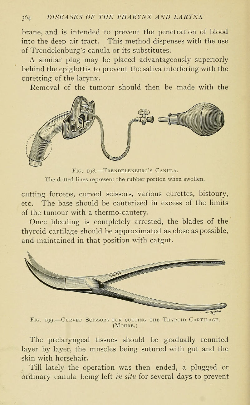 brane, and is intended to prevent the penetration of blood into the deep air tract. This method dispenses with the use of Trendelenburg's canula or its substitutes. A similar plug may be placed advantageously superiorly behind the epiglottis to prevent the saliva interfering with the curetting of the larynx. Removal of the tumour should then be made with the Fig. 198.—Trendelexburg's Canula. The dotted lines represent the rubber portion when swollen. cutting forceps, curved scissors, various curettes, bistoury, etc. The base should be cauterized in excess of the limits of the tumour with a thermo-cautery. Once bleeding is completely arrested, the blades of the thyroid cartilage should be approximated as close as possible, and maintained in that position wath catgut. Fig. .—Curved Scissors for cutting the Thyroid Cartilage. (Moure.) The prelaryngeal tissues should be gradually reunited layer by layer, the muscles being sutured with gut and the skin with horsehair. Till lately the operation w^as then ended, a plugged or ordinar}^ canula being left in situ for several days to prevent