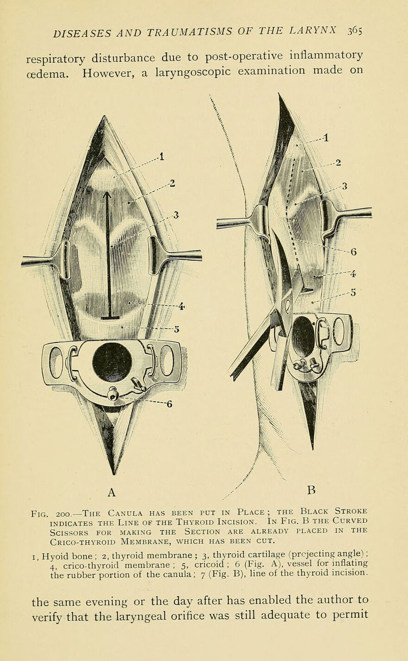 respiratory disturbance due to post-operative inflammatory œdema. However, a laryngoscopic examination made on Fig. 200.—The Canula has been put in Place ; the Black Stroke INDICATES the LiNE OF THE ThYROID InCISION. In FIG. B THE CuRVED Scissors for making the Section are already placed in the Crico-thyroid Membrane, which has been cut. I, Hyoid bone ; 2, thyroid membrane ; 3, thyroid cartilage (prcjecting angle) ; 4, crico-thyroid membrane ; 5, cricoid ; 6 (Fig. A), vessel for inflating the rubber portion of the canula; 7 (Fig. B), line of the thyroid incision. the same evening or the day after has enabled the author to verify that the laryngeal orifice was still adequate to permit