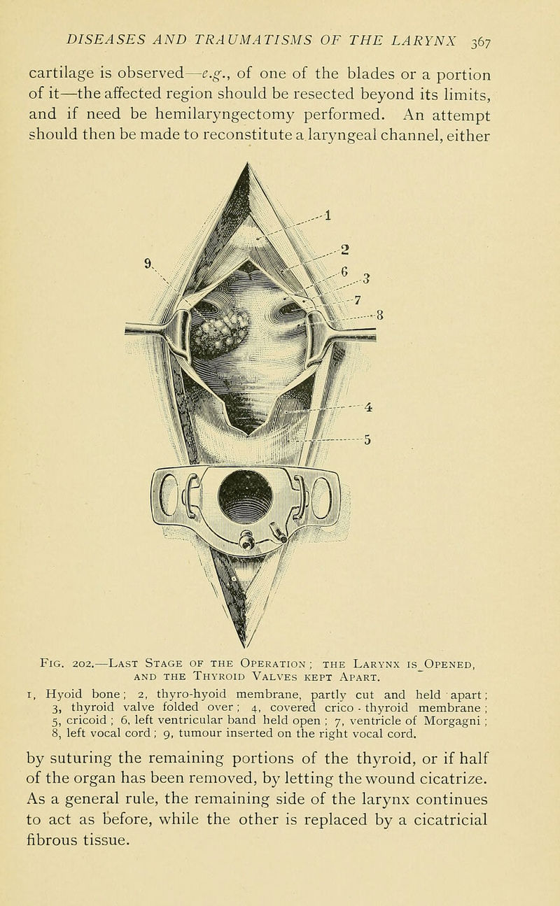 cartilage is observed—e.g., of one of the blades or a portion of it—the affected region should be resected beyond its limits, and if need be hemilaryngectomy performed. An attempt should then be made to reconstitute a laryngeal channel, either Fig. 202.—Last Stage of the Operation ; the Larynx is_Opened, AND THE Thyroid Valves kept Apart. I, Hyoid bone; 2, thyro-hyoid membrane, partly cut and held apart ; 3, thyroid valve folded over ; 4, covered crico - thyroid membrane ; 5, cricoid ; 6, left ventricular band held open ; 7, ventricle of Morgagni ; 8, left vocal cord ; 9, tumour inserted on the right vocal cord. by suturing the remaining portions of the thyroid, or if half of the organ has been removed, by letting the wound cicatrize. As a general rule, the remaining side of the larynx continues to act as before, while the other is replaced by a cicatricial fibrous tissue.