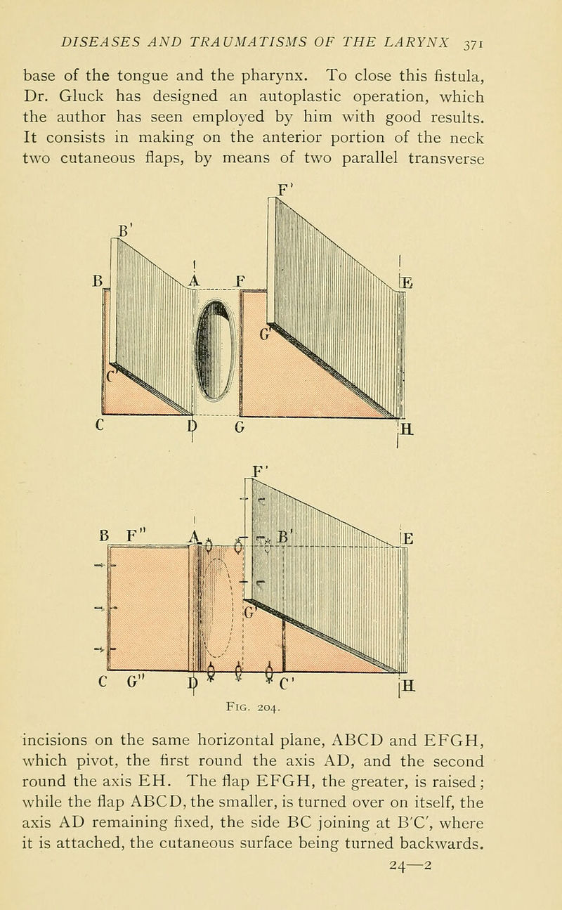 base of the tongue and the pharynx. To close this fistula, Dr. Gluck has designed an autoplastic operation, which the author has seen employed by him with good results. It consists in making on the anterior portion of the neck two cutaneous flaps, by means of two parallel transverse incisions on the same horizontal plane, ABCD and EFGH, which pivot, the first round the axis AD, and the second round the axis EH. The flap EFGH, the greater, is raised; while the flap ABCD, the smaller, is turned over on itself, the axis AD remaining fixed, the side BC joining at B'C', where it is attached, the cutaneous surface being turned backwards. 24—2