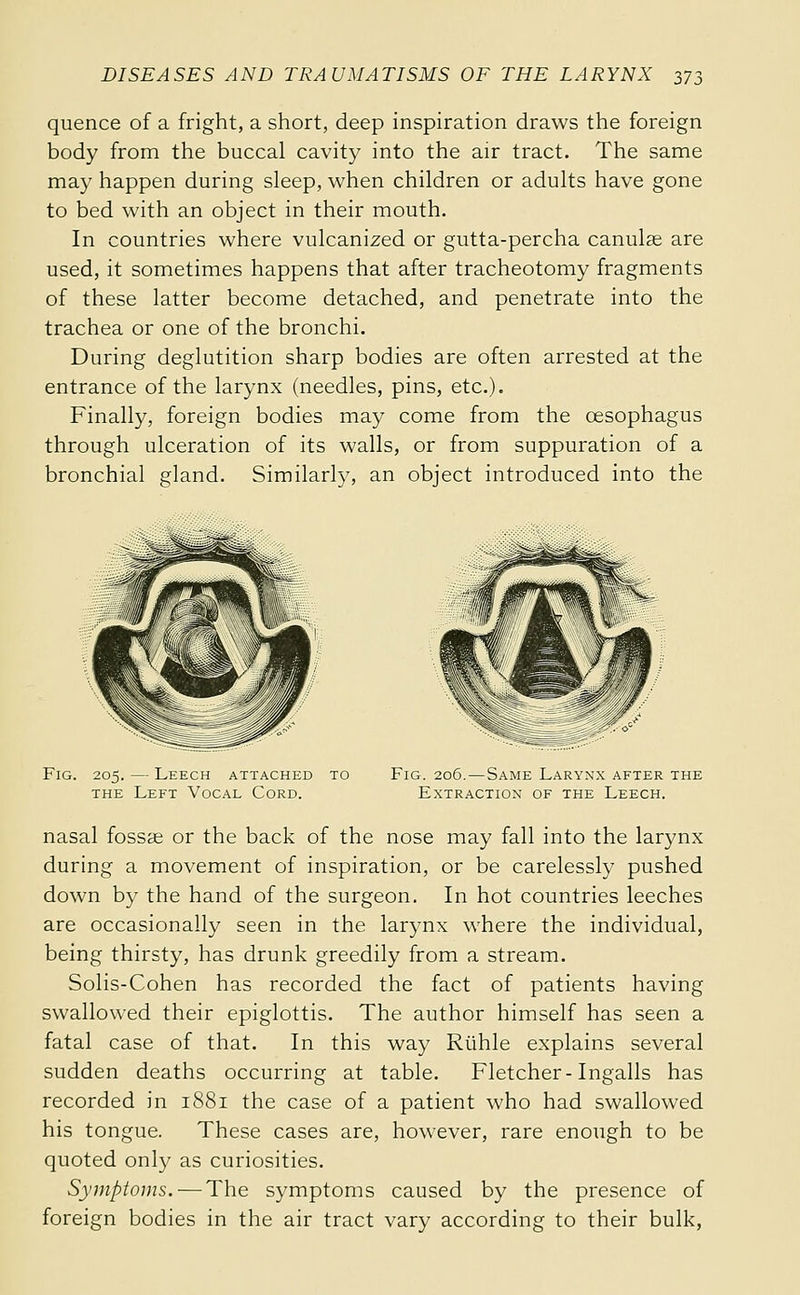 quence of a fright, a short, deep inspiration draws the foreign body from the buccal cavity into the air tract. The same may happen during sleep, when children or adults have gone to bed with an object in their mouth. In countries where vulcanized or gutta-percha canulse are used, it sometimes happens that after tracheotomy fragments of these latter become detached, and penetrate into the trachea or one of the bronchi. During deglutition sharp bodies are often arrested at the entrance of the larynx (needles, pins, etc.). Finally, foreign bodies may come from the œsophagus through ulceration of its walls, or from suppuration of a bronchial gland. Similarly, an object introduced into the Fig. 205. — Leech attached to THE Left Vocal Cord. Fig. 2o5.—Same Larynx after the Extraction of the Leech. nasal fossae or the back of the nose may fall into the larynx during a movement of inspiration, or be carelessly pushed down by the hand of the surgeon. In hot countries leeches are occasionally seen in the larynx where the individual, being thirsty, has drunk greedily from a stream. Solis-Cohen has recorded the fact of patients having swallowed their epiglottis. The author himself has seen a fatal case of that. In this way Riihle explains several sudden deaths occurring at table. Fletcher-Ingalls has recorded in 1881 the case of a patient who had swallowed his tongue. These cases are, however, rare enough to be quoted only as curiosities. Symptoms. — The symptoms caused by the presence of foreign bodies in the air tract vary according to their bulk,