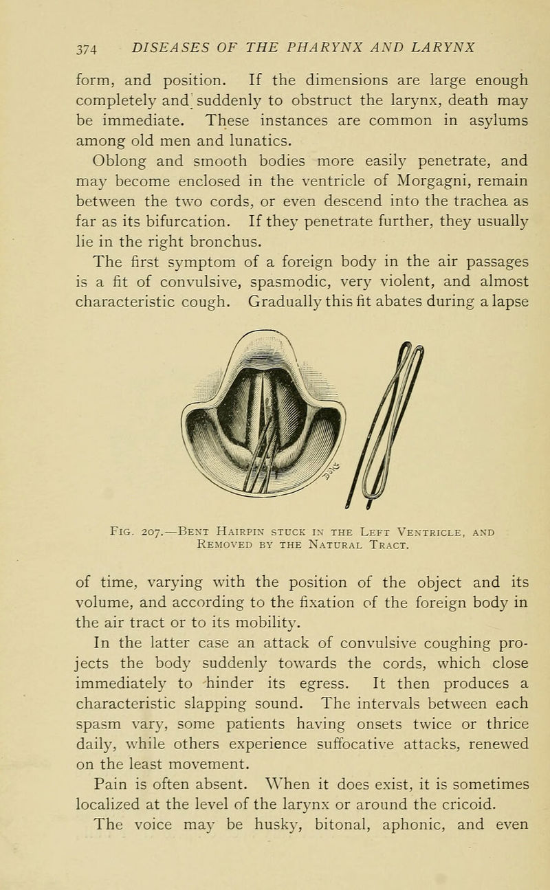 form, and position. If the dimensions are large enough completely and_ suddenly to obstruct the larynx, death may be immediate. These instances are common in asylums among old men and lunatics. Oblong and smooth bodies more easily penetrate, and may become enclosed in the ventricle of Morgagni, remain between the two cords, or even descend into the trachea as far as its bifurcation. If they penetrate further, they usually lie in the right bronchus. The first symptom of a foreign body in the air passages is a fit of convulsive, spasmodic, very violent, and almost characteristic cough. Gradually this fit abates during a lapse Fig. 207.—Bent Hairpin stuck in the Left Ventricle, and Removed by the Natural Tract. of time, varying with the position of the object and its volume, and according to the fixation of the foreign body in the air tract or to its mobility. In the latter case an attack of convulsive coughing pro- jects the body suddenly towards the cords, which close immediately to hinder its egress. It then produces a characteristic slapping sound. The intervals between each spasm var}', some patients having onsets twice or thrice daily, while others experience suftbcative attacks, renewed on the least movement. Pain is often absent. \\'hen it does exist, it is sometimes localized at the level of the larynx or around the cricoid. The voice may be husky, bitonal, aphonic, and even