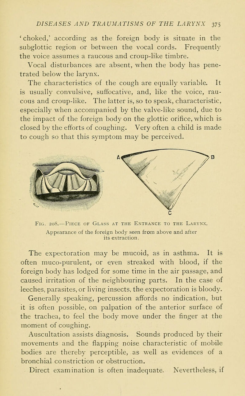 ' choked,' according as the foreign body is situate in the subglottic region or between the vocal cords. Frequently the voice assumes a raucous and croup-like timbre. Vocal disturbances are absent, when the body has pene- trated below the larynx. The characteristics of the cough are equally variable. It is usually convulsive, suffocative, and, like the voice, rau- cous and croup-like. The latter is, so to speak, characteristic, especially when accompanied by the valve-like sound, due to the impact of the foreign body on the glottic orifice, which is closed by the efforts of coughing. Very often a child is made to cough so that this symptom may be perceived. Fig. 208.—Piece of Glass at the Entrance to the Larynx. Appearance of the foreign body seen from above and after its extraction. The expectoration may be mucoid, as in asthma. It is often muco-purulent, or even streaked with blood, if the foreign body has lodged for some time in the air passage, and caused irritation of the neighbouring parts. In the case of leeches, parasites, or living insects, the expectoration is bloody. Generally speaking, percussion affords no indication, but it is often possible, on palpation of the anterior surface of the trachea, to feel the body move under the finger at the moment of coughing. Auscultation assists diagnosis. Sounds produced by their movements and the flapping noise characteristic of mobile bodies are thereby perceptible, as well as evidences of a bronchial constriction or obstruction. Direct examination is often inadequate. Nevertheless, if