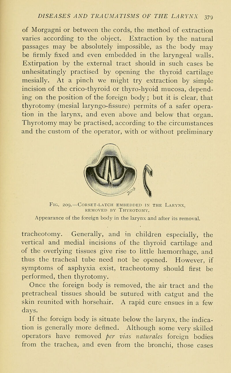of Morgagni or between the cords, the method of extraction varies according to the object. Extraction by the natural passages may be absolutely impossible, as the body may be firmly fixed and even embedded in the laryngeal walls. Extirpation by the external tract should in such cases be unhesitatingly practised by opening the thyroid cartilage mesially. At a pinch we might try extraction by simple incision of the crico-thyroid or thyro-hyoid mucosa, depend- ing on the position of the foreign body ; but it is clear, that thyrotomy (mesial laryngo-fissure) permits of a safer opera- tion in the larynx, and even above and below that organ. Thyrotomy may be practised, according to the circumstances and the custom of the operator, with or without preliminary Fig. 209.—Corset-latch embedded in the Larynx, REMOVED BY ThYROTOMY. Appearance of the foreign body in the larynx and after its removal. tracheotomy. Generally, and in children especially, the vertical and medial incisions of the thyroid cartilage and of the overlying tissues give rise to little hsemorrhage, and thus the tracheal tube need not be opened. However, if symptoms of asphyxia exist, tracheotomy should first be performed, then thyrotomy. Once the foreign body is removed, the air tract and the pretracheal tissues should be sutured with catgut and the skin reunited with horsehair. A rapid cure ensues in a few days. If the foreign body is situate below the larynx, the indica- tion is generally more defined. Although some very skilled operators have removed per vins naturales foreign bodies from the trachea, and even from the bronchi, those cases