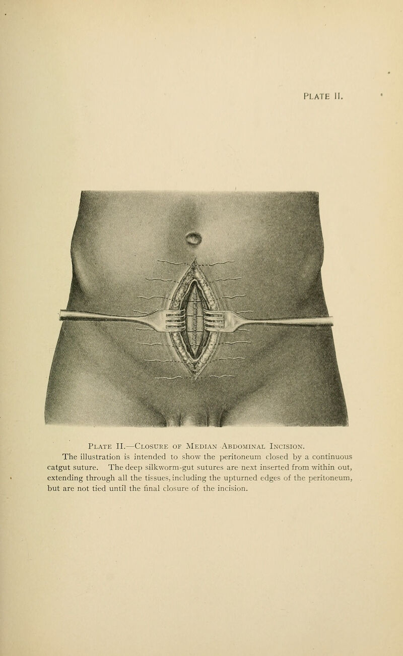 FOLATE Plate II.—Closure of Median Abdominal Incision. The illustration is intended to show the peritoneum closed by a continuous catgut suture. The deep silkworm-gut sutures are next inserted from within out, extending through all the tissues, including the upturned edges of the peritoneum, but are not tied until the final closure of the incision.