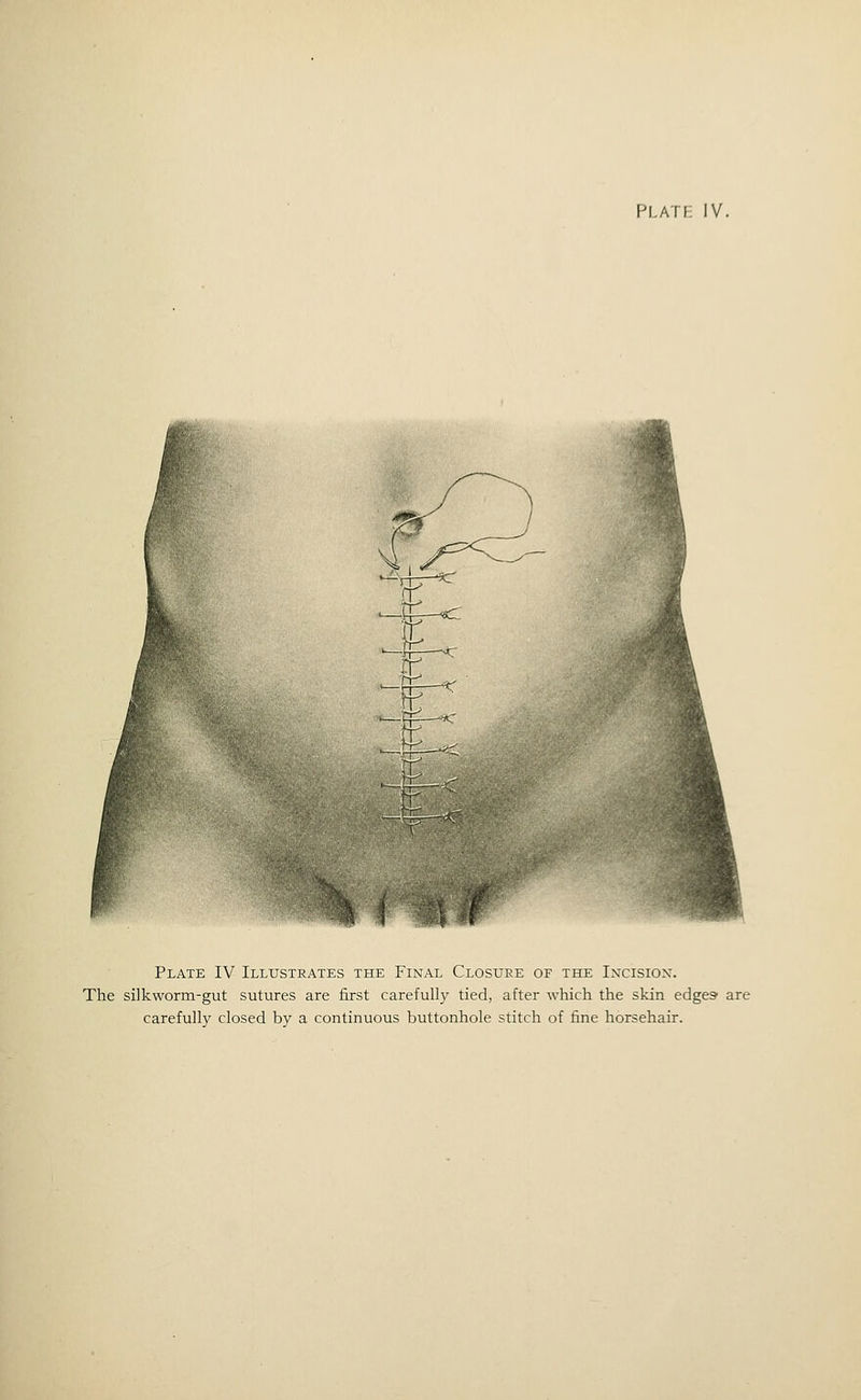 Platf IV. Plate IV Illustrates the Final Closure of the Incision. The silkworm-gut sutures are first carefully tied, after which the skin edges are carefully closed by a continuous buttonhole stitch of fine horsehair.