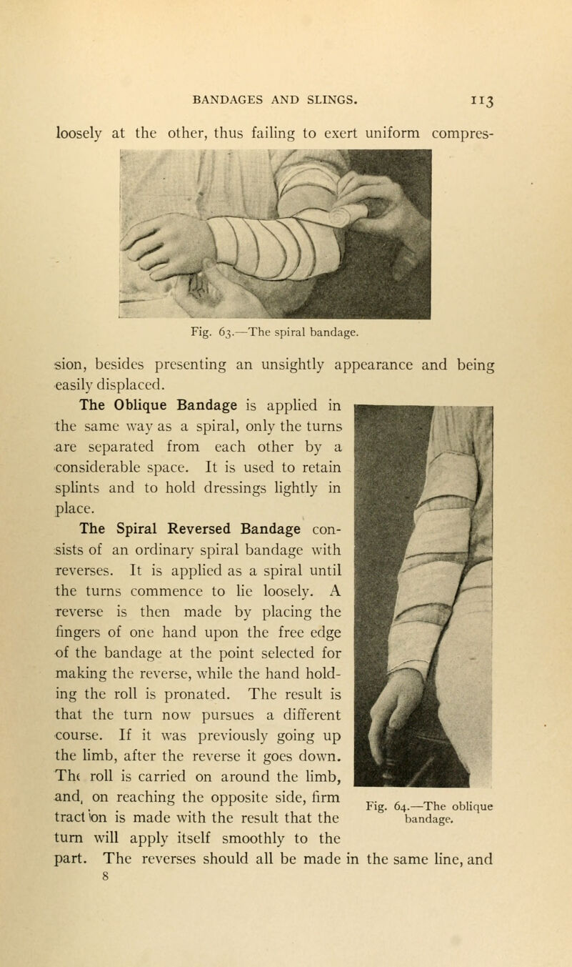 loosely at the other, thus failing to exert uniform compres- y^ Fig. 63.—The spiral bandage. sion, besides presenting an unsightly appearance and being easily displaced. The Oblique Bandage is appHed in the same way as a spiral, only the turns are separated from each other by a considerable space. It is used to retain sphnts and to hold dressings lightly in place. The Spiral Reversed Bandage con- sists of an ordinary spiral bandage with reverses. It is applied as a spiral until the turns commence to he loosely. A reverse is then made by placing the fingers of one hand upon the free edge of the bandage at the point selected for making the reverse, while the hand hold- ing the roll is pronated. The result is that the turn now pursues a different course. If it was previously going up the Hmb, after the reverse it goes down. Th( roll is carried on around the limb, and, on reaching the opposite side, firm traction is made with the result that the turn will apply itself smoothly to the part. The reverses should all be made in the same line, and 8 Fig. 64.—The oblique bandage.