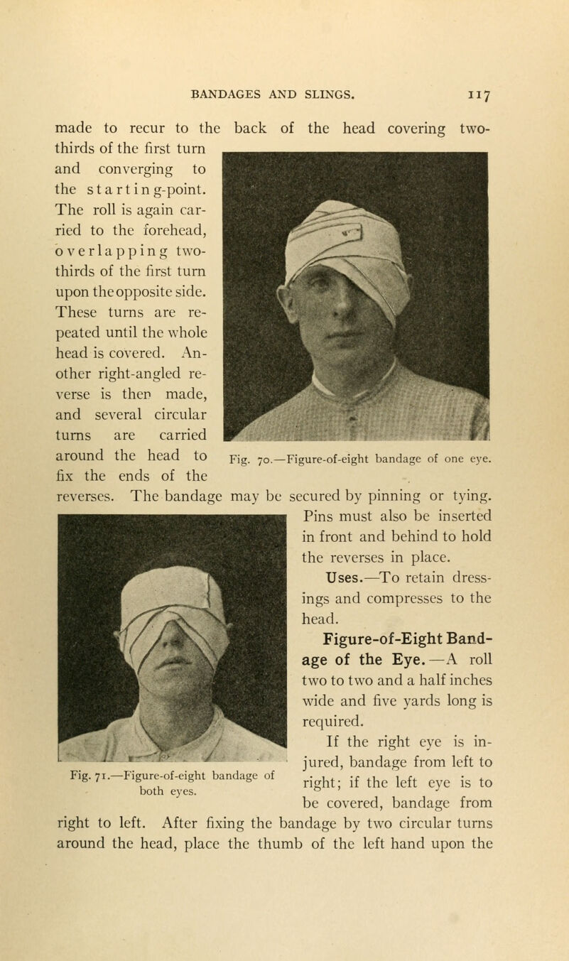 the head covering two- Fig. 70.—Figure-of-eight bandage of one eye. made to recur to the back of thirds of the first turn and converging to the starting-point. The roll is again car- ried to the forehead, overlapping two- thirds of the first turn upon the opposite side. These turns are re- peated until the whole head is covered. An- other right-angled re- verse is then made, and several circular turns are carried around the head to fix the ends of the reverses. The bandage may be secured by pinning or tying. Pins must also be inserted in front and behind to hold the reverses in place. Uses.—^To retain dress- ings and compresses to the head. Figure-of-Eight Band- age of the Eye.—A roll two to two and a half inches wide and five yards long is required. If the right eye is in- jured, bandage from left to right; if the left eye is to be covered, bandage from right to left. After fixing the bandage by two circular turns around the head, place the thumb of the left hand upon the Fig. 71.—Figure-of-eight bandage of both eyes.