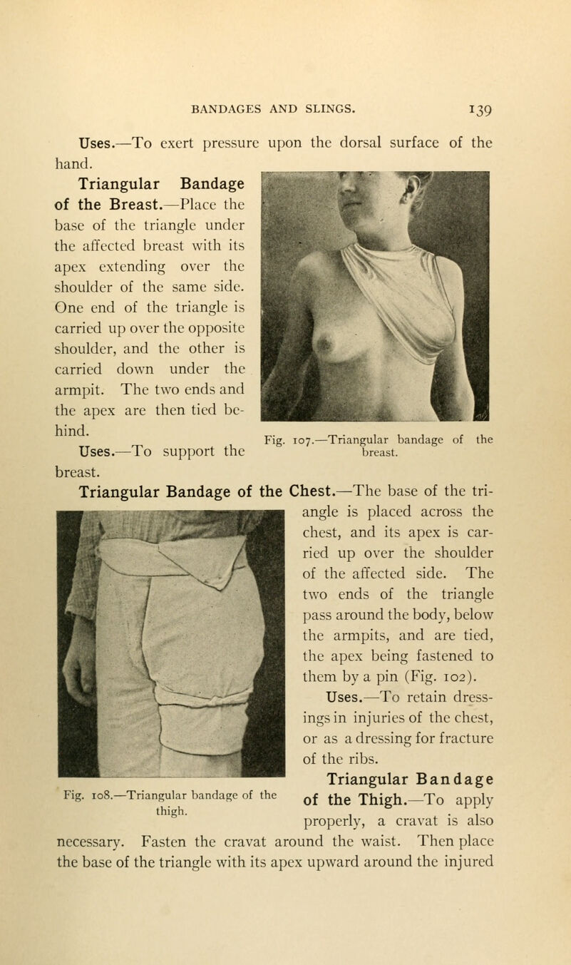 Fig. 107.—Triangular bandage of the breast. Uses.—To exert pressure upon the dorsal surface of the hand. Triangular Bandage of the Breast.—Place the base of the triangle under the affected breast with its apex extending over the shoulder of the same side. One end of the triangle is carried up over the opposite shoulder, and the other is carried down under the armpit. The two ends and the apex are then tied be- hind. Uses.—To support the breast. Triangular Bandage of the Chest.—The base of the tri- angle is placed across the chest, and its apex is car- ried up over the shoulder of the affected side. The two ends of the triangle pass around the body, below the armpits, and are tied, the apex being fastened to them by a pin (Fig. 102). Uses.—To retain dress- ings in injuries of the chest, or as a dressing for fracture of the ribs. Triangular Bandage of the Thigh.—To apply properly, a cravat is also necessary. Fasten the cravat around the waist. Then place the base of the triangle with its apex upward around the injured Fig. K -Triangular bandage of the thigh.