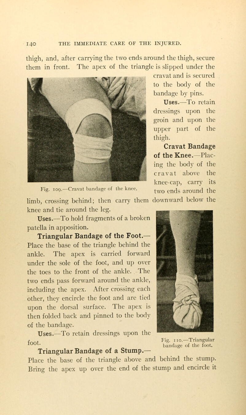 thigh, and, after carrying the two ends around the thigh, secure them in front. The apex of the triangle is shpped under the cravat and is secured to the body of the bandage by pins. Uses.—To retain dressings upon the groin and upon the upper part of the thigh. Cravat Bandage of the Knee.—Plac- ing the body of the cravat above the knee-cap, carry its Fig. log.-Cravat bandage of the knee. ^^^ ^^^^ arOUnd thc limb, crossing behind; then carry them downward below the knee and tie around the leg. Uses.—To hold fragments of a broken patella in apposition. Triangular Bandage of the Foot.— Place the base of the triangle behind the ankle. The apex is carried forward under the sole of the foot, and up over the toes to the front of the ankle. The two ends pass forward around the ankle, including the apex. After crossing each other, they encircle the foot and are tied upon the dorsal surface. The apex is then folded back and pinned to the body of the bandage. Uses.—To retain dressings upon the foot. Triangular Bandage of a Stump.— Place the base of the triangle above and behind the stump. Bring the apex up over the end of the stump and encircle it Fig. no.—Triangular bandage of the foot.