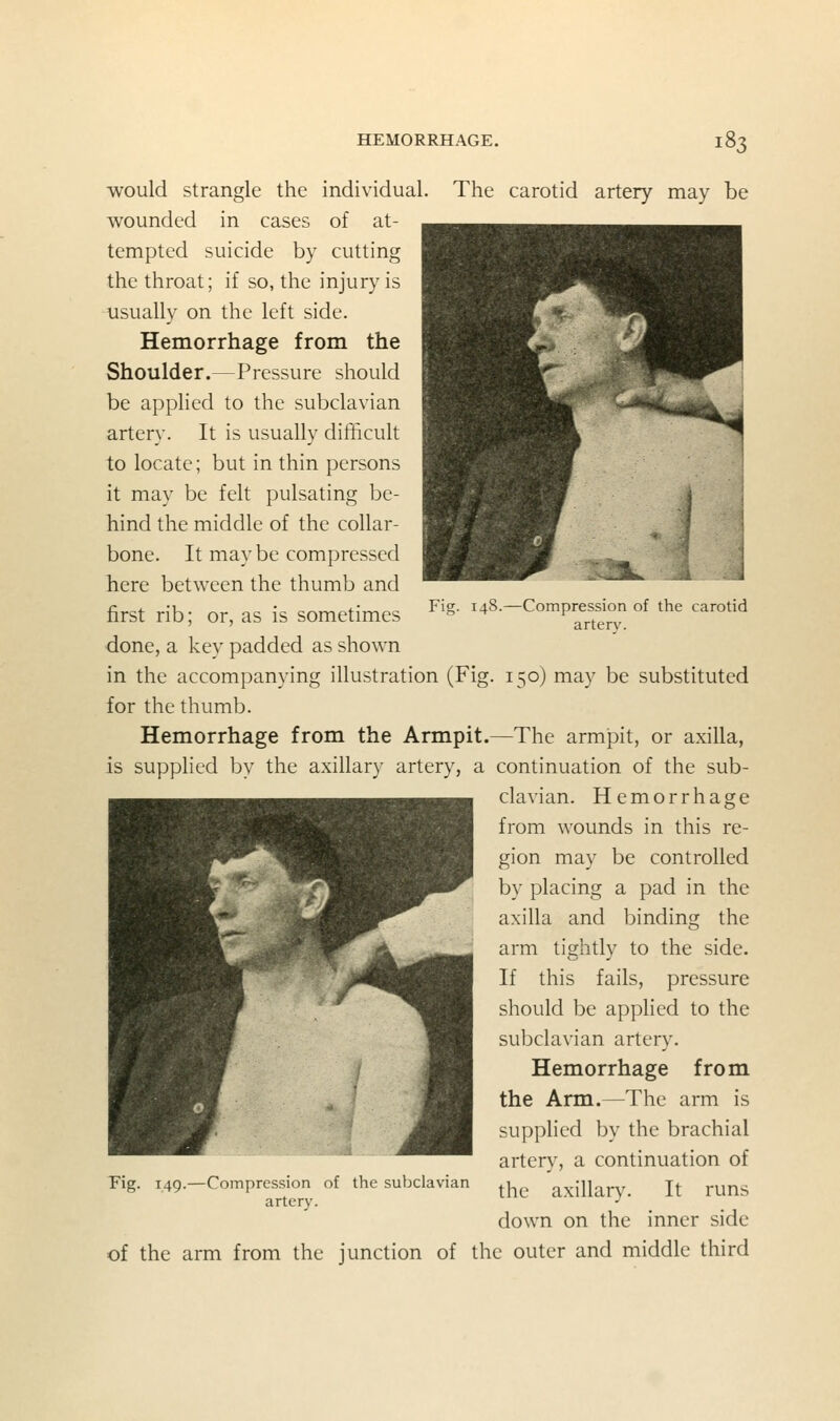 Fig. 148.—Compression of the carotid artery. would strangle the individual. The carotid artery may be wounded in cases of at- tempted suicide by cutting the throat; if so, the injury is usually on the left side. Hemorrhage from the Shoulder.—Pressure should be applied to the subclavian artery. It is usually difficult to locate; but in thin persons it may be felt pulsating be- hind the middle of the collar- bone. It may be compressed here between the thumb and first rib; or, as is sometimes •done, a key padded as shown in the accompanying illustration (Fig. 150) may be substituted for the thumb. Hemorrhage from the Armpit.—The armpit, or axilla, is supplied by the axillary artery, a continuation of the sub- clavian. Hemorrhage from wounds in this re- gion may be controlled by placing a pad in the axilla and binding the arm tightly to the side. If this fails, pressure should be applied to the subclavian artery. Hemorrhage from the Arm.—The arm is supplied by the brachial artery, a continuation of the axillary. It runs down on the inner side of the arm from the junction of the outer and middle third Fig. 149. -Compression of the subclavian artery.