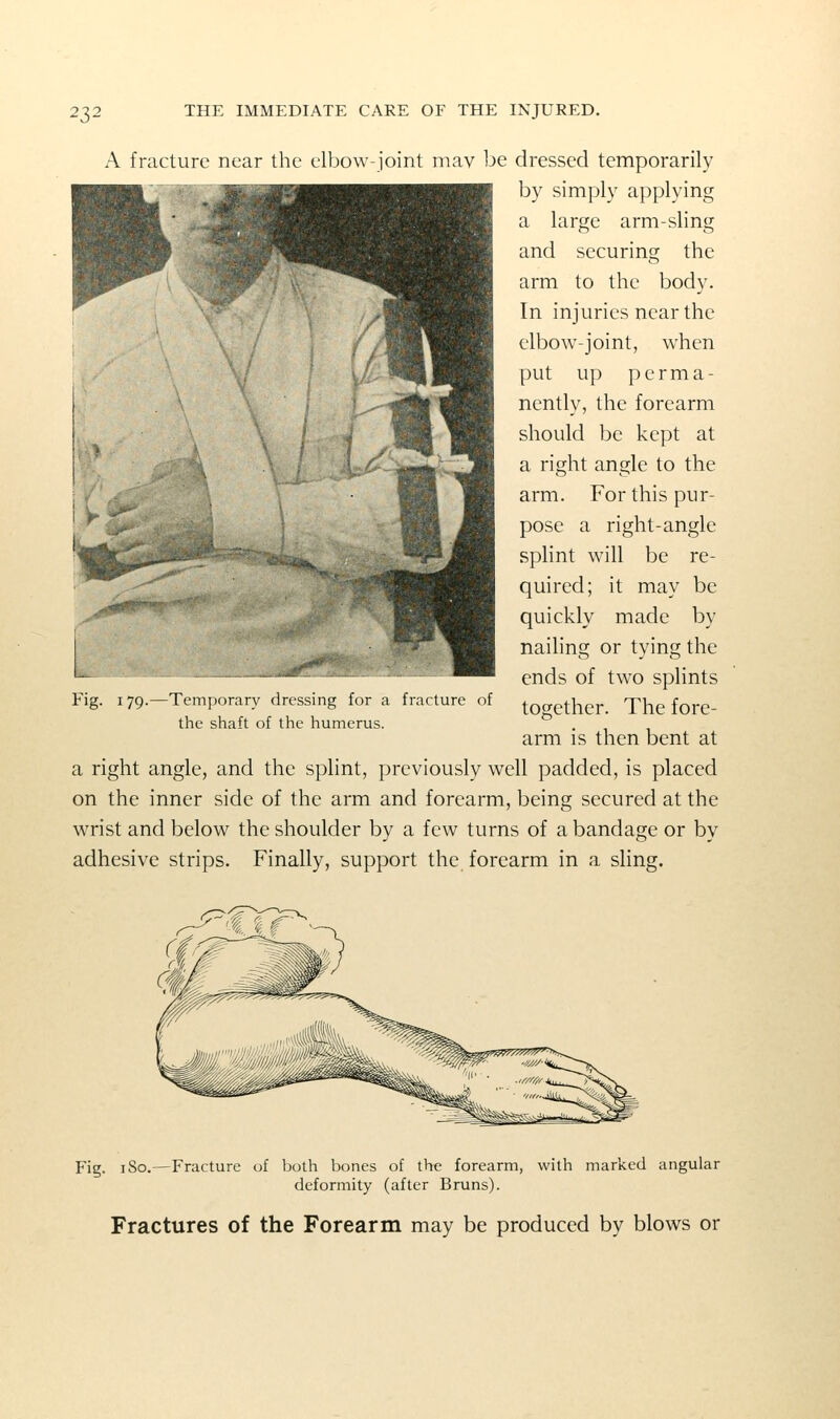 A fracture near the elbow-joint mav be dressed temporarily by simply applying a large arm-sling and securing the arm to the body. In injuries near the elbow-joint, when put up perma- nently, the forearm should be kept at a right angle to the arm. For this pur- pose a right-angle splint will be re- quired; it may be quickly made by nailing or tying the ends of two splints together. The fore- arm is then bent at a right angle, and the splint, previously well padded, is placed on the inner side of the arm and forearm, being secured at the wrist and below the shoulder by a few turns of a bandage or by adhesive strips. Finally, support the forearm in a shng. Fig. 179.—Tcni[)()rar\- dressing for a fracture of the shaft of the humerus. Fig. iSo.—Fracture of both bones of the forearm, with marked angular deformity (after Bruns). Fractures of the Forearm may be produced by blows or