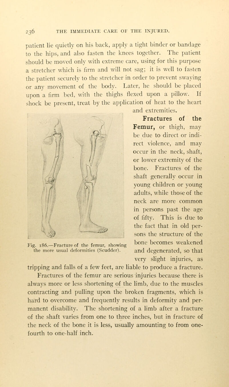 u patient lie quietly on his back, apply a tight binder or bandage to the hips, and also fasten the knees together. The patient should be moved only with extreme care, using for this purpose a stretcher which is firm and wih not sag; it is well to fasten the patient securely to the stretcher in order to prevent swaying or any movement of the body. Later, he should be placed upon a firm bed, with the thighs flexed upon a pillow. If shock be present, treat by the apphcation of heat to the heart and extremities. Fractures of the ; ; r Femur, or thigh, may ,J^^% f'-^h : be due to direct or indi- 'j \ \ \ rect violence, and may ' ' occur in the neck, shaft, / or lower extremity of the 7\ bone. Fractures of the \} W shaft generally occur in CI' young children or young I I ' adults, while those of the neck are more common in persons past the age of fifty. This is due to } the fact that in old per- .^^ '^ sons the structure of the T7- c< T7 ♦ * .1, <• „ .1,^ ;,,„ bone becomes weakened Fig. 186.—Fracture of the femur, showing the more usual deformities (Scudder). and degenerated, SO that very slight injuries, as tripping and falls of a few feet, are liable to produce a fracture. Fractures of the femur are serious injuries because there is always more or less shortening of the limb, due to the muscles contracting and pulling upon the broken fragments, which is hard to overcome and frequently results in deformity and per- manent disability. The shortening of a limb after a fracture of the shaft varies from one to three inches, but in fracture of the neck of the bone it is less, usually amounting to from one- fourth to one-half inch. 1^