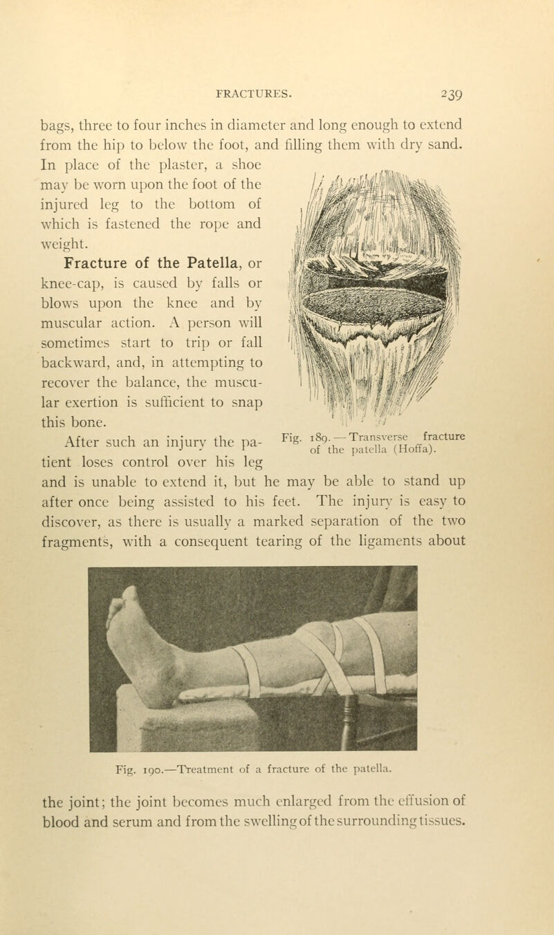 bags, three to four inches in diameter and long enough to extend from the hip to below the foot, and filling them with dry sand. In place of the plaster, a shoe may be worn upon the foot of the injured leg to the bottom of which is fastened the rope and weight. Fracture of the Patella, or knee-cap, is caused by falls or blows upon the knee and by muscular action. A person will sometimes start to trij) or fall backward, and, in attempting to recover the balance, the muscu- lar exertion is sufficient to snap this bone. After such an injury the pa- tient loses control over his leg and is unable to extend it, but he may be able to stand up after once being assisted to his feet. The injury is easy to discover, as there is usually a marked separation of the two fragments, with a consequent tearing of the ligaments about Fig. 189.—Transverse fracture of the patella (Hoffa). Fig. I go.—Treatment of a fracture of the patella. the joint; the joint becomes much enlarged from the effusion of blood and serum and from the swelling of the surrounding tissues.