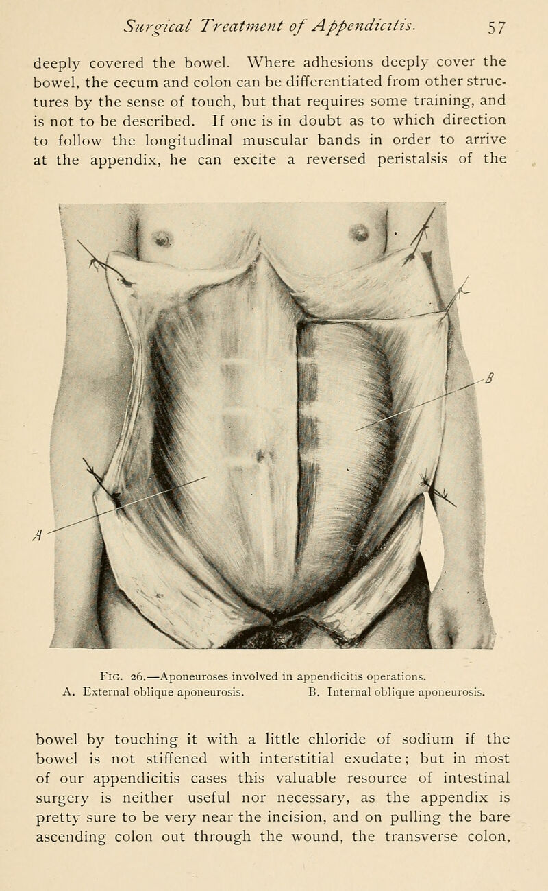 deeply covered the bowel. Where adhesions deeply cover the bowel, the cecum and colon can be differentiated from other struc- tures by the sense of touch, but that requires some training, and is not to be described. If one is in doubt as to which direction to follow the longitudinal muscular bands in order to arrive at the appendix, he can excite a reversed peristalsis of the Fig. 26.—Aponeuroses involved in appendicitis operations. A. External oblique aponeurosis. B. Internal oblique aponeurosis. bowel by touching it with a little chloride of sodium if the bowel is not stiffened with interstitial exudate; but in most of our appendicitis cases this valuable resource of intestinal surgery is neither useful nor necessary, as the appendix is pretty sure to be very near the incision, and on pulling the bare ascending colon out through the wound, the transverse colon,