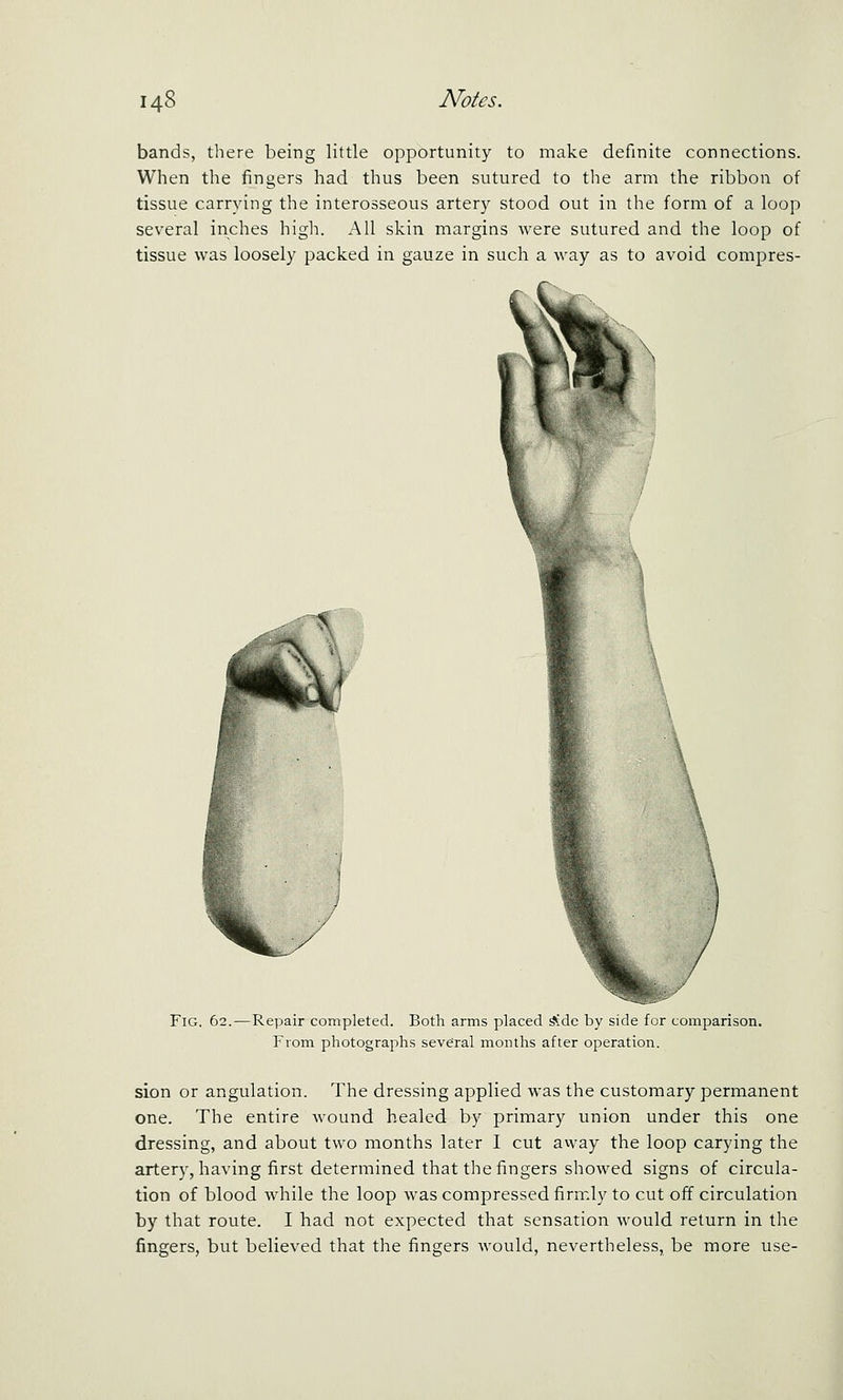 bands, there being little opportunity to make definite connections. When the fingers had thus been sutured to tlie arm the ribbon of tissue carrying the interosseous artery stood out in the form of a loop several inches high. All skin margins were sutured and the loop of tissue was loosely packed in gauze in such a way as to avoid compres- FiG. 62.—Repair completed. Both arms placed ^de by side for comparison. From photographs seve'ral months after operation. sion or angulation. The dressing applied was the customary permanent one. The entire wound healed by primary union under this one dressing, and about two months later I cut avvay the loop carying the artery, having first determined that the fingers showed signs of circula- tion of blood while the loop was compressed firmly to cut off circulation by that route. I had not expected that sensation would return in the fingers, but believed that the fingers would, nevertheless, be more use-