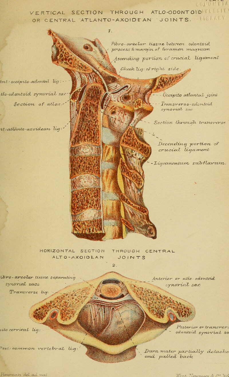 VERTICAL SECTION THROUGH ATLO-ODONT Ol D OR CENTRAL ATLANTO - AXOI D T AN JOINTS- \-nt: occijoito-eUlmitM tLo-odori-toid- sryno-i-'iril- Sect/io-n. of cK^tLcts.^ tt.-atli'vnto-citxo-id^a^v Zi^ A.sce*uAjJng -portion of crouxccL Ixcjcanent Chcok.li.ij tfyialit sic^e. - Ocapiio ctilccntfj' joint Xrcavsyers o - oclo-y\JxruL syyvoviah scjj; - Section (Jwori-cih. ti'-a.yxsversf Decenf^xn^Oj -joor'tborc oP HORIZONTAL StCTIOM THROUGH CENTRAL ALTO-/\XOIDt.AN JOirsJTS 2. synxiYtyOjL solc^ liio cefyurcct h^ /^* '^ \^^M Antei'vor' or octia - ooloixtaici iyyvoyi,CfX. sac ^ost- Gomtvton- \'c vt&hr cub li.  odorucid, synovtaX Sa J) TXfct- -mctte;r -pcLr tx-ocLly cieJxA^ie* and TouXLeA lootcl^ rJensrvu^.ii. del.ouv.riccc