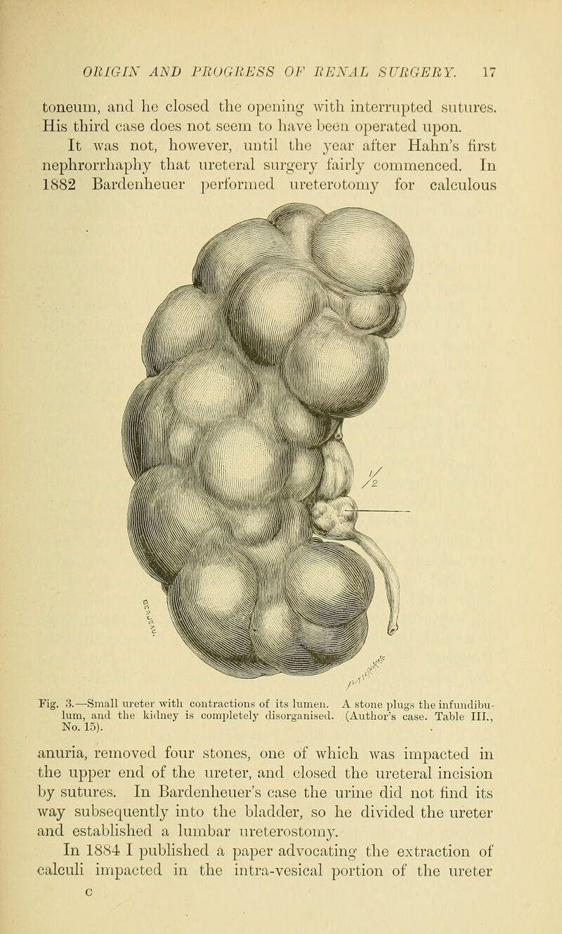 tbn.eu.in, and he closed the opening Avith interrupted sutures. His third case does not seem to have been operated upon. It was not, however, until the }^ear after Harm's first nephrorrhaphy that ureteral surgery fairly commenced. In 1882 Bardenheuer performed ureterotomy for calculous Fig. 3.—Small ureter with contractions of its lumen. A stone plugs the infundibu- lum, and the kidney is completely disorganised. (Author's case. Table III., No. 15). anuria, removed four stones, one of which was impacted in the upper end of the ureter, and closed the ureteral incision by sutures. In Bardenheuer's case the urine did not find its way subsequently into the bladder, so he divided the ureter and established a lumbar ureterostomy. In 1884 I published a paper advocating the extraction of calculi impacted in the intra-vesical portion of the ureter c