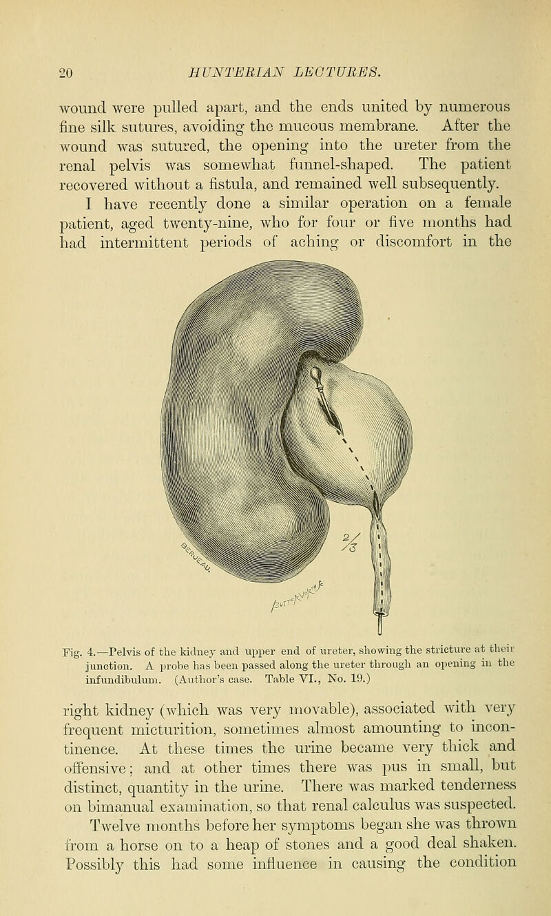 wound were pulled apart, and the ends united by numerous fine silk sutures, avoiding the mucous membrane. After the wound was sutured, the opening into the ureter from the renal pelvis was somewhat funnel-shaped. The patient recovered without a fistula, and remained well subsequently. I have recently done a similar operation on a female patient, aged twenty-nine, who for four or five months had had intermittent periods of aching or discomfort in the Fig. 4.—Pelvis of the kidney and upper end of ureter, showing the stricture at then- junction. A probe has been passed along the ureter through an opening in the infundibulum. (Author's case. Table VI., No. 19.) right kidney (which was very movable), associated with very frequent micturition, sometimes almost amounting to incon- tinence. At these times the urine became very thick and offensive; and at other times there was pus in small, but distinct, quantity in the urine. There was marked tenderness on bimanual examination, so that renal calculus was suspected. Twelve months before her symptoms began she was thrown from a horse on to a heap of stones and a good deal shaken. Possibly this had some influence in causing the condition