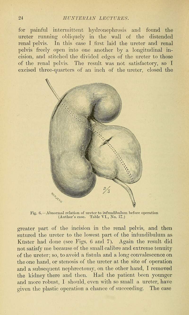 for painful intermittent hydronephrosis and found the ureter running obliquely in the wall of the distended renal pelvis. In this case I first laid the ureter and renal pelvis freely open into one another by a longitudinal in- cision, and stitched the divided edges of the ureter to those of the renal pelvis. The result was not satisfactory, so I excised three-quarters of an inch of the ureter, closed the Fig. 6. —Abnormal relation of ureter to infundibulum before operation (Author's case. Table VI., No. 17.) greater part of the incision in the renal pelvis, and then sutured the ureter to the lowest part of the infundibulum as Ktister had done (see Figs. 6 and 7). Again the result did not satisfy me because of the small calibre and extreme tenuity of the ureter; so, to avoid a fistula and a long convalescence on the one hand, or stenosis of the ureter at the site of operation and a subsequent nephrectomy, on the other hand, I removed the kidney there and then. Had the patient been younger and more robust, I should, even with so small a ureter, have given the plastic operation a chance of succeeding. The case