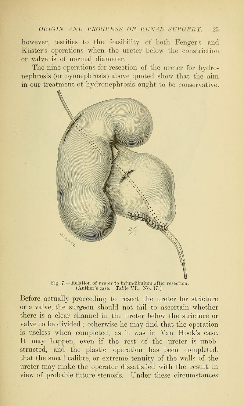 however, testifies to the feasibility of both Fenger's and Bolster's operations when the ureter below the constriction or valve is of normal diameter. The nine operations for resection of the ureter for hydro- nephrosis (or pyonephrosis) above quoted show that the aim in our treatment of hydronephrosis ought to be conservative. Fig. 7.- -Eelation of ureter to infundibulum after resection. (Author's case. Table VI., No. 17.) Before actually proceeding to resect the ureter lor stricture or a valve, the surgeon should not fail to ascertain whether there is a clear channel in the ureter below the stricture or valve to be divided; otherwise he may find that the operation is useless when completed, as it was in Van Hook's case. It may happen, even if the rest of the ureter is unob- structed, and the plastic operation has been completed, that the small calibre, or extreme tenuity of the walls of the ureter may make the operator dissatisfied with the result, in view of probable future stenosis. Under these circumstances