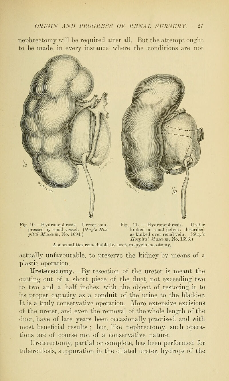 nephrectomy will be required after all. But the attempt ought to be made, in every instance where the conditions are not Fig. 10.—Hydronephrosis. Ureter com- Fig. 11.—-Hydronephrosis. Ureter pressed by renal vessel. {Guy's Hos- kinked on renal pelvis : described pital Museum, No. 1G94.) as kinked over renal vein. (Guy's Hospital Museum, No. 1693.) Abnormalities remediable by uretero-pyelo-neostomy. actually unfavourable, to preserve the kidney by means of a plastic operation. Ureterectomy.—By resection of the ureter is meant the cutting out of a short piece of the duct, not exceeding' two to two and a half inches, with the object of restoring it to its proper capacity as a conduit of the urine to the bladder. It is a truly conservative operation. More extensive excisions of the ureter, and even the removal of the whole length of the duct, have of late years been occasionally practised, and with most beneficial results ; but, like nephrectomy, such opera- tions are of course not of a conservative nature. Ureterectomy, partial or complete, has been performed for tuberculosis, suppuration in the dilated ureter, hydrops of the