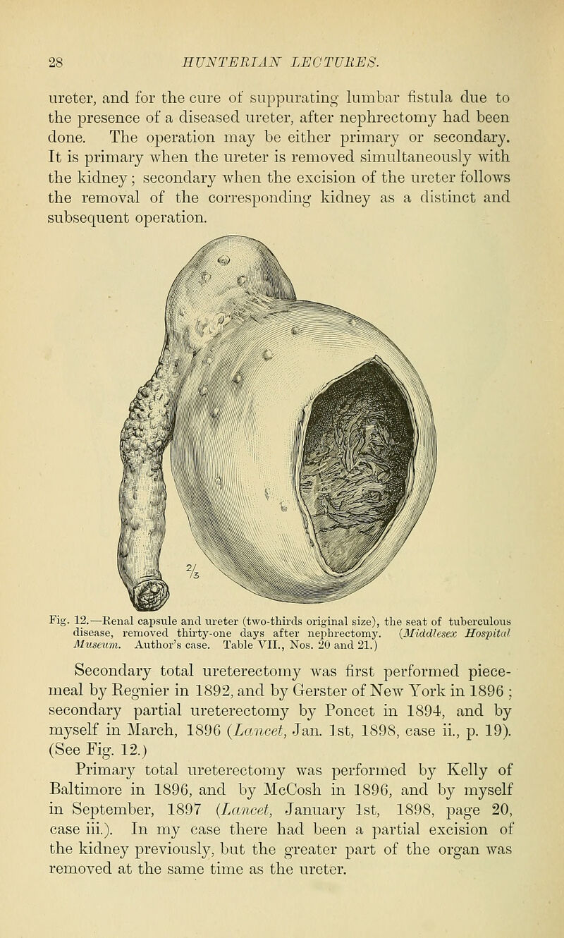 ureter, and for the cure of suppurating lumbar fistula due to the presence of a diseased ureter, after nephrectomy had been done. The operation may be either primary or secondary. It is primary when the ureter is removed simultaneously with the kidney; secondary when the excision of the ureter follows the removal of the corresponding kidney as a distinct and subsequent operation. Fig. 12.—Renal capsule and ureter (two-thirds original size), the seat of tuberculous disease, removed thirty-one days after nephrectomy. (Middlesex Hospital Museum. Author's case. Table VII., Nos. 20 and 21.) Secondary total ureterectomy was first performed piece- meal by Regnier in 1892, and by Gerster of New York in 1896 ; secondary partial ureterectomy by Poncet in 1894, and by myself in March, 1896 (Lancet, Jan. 1st, 1898, case ii., p. 19). (See Fig. 12.) Primary total ureterectomy was performed by Kelly of Baltimore in 1896, and by McCosh in 1896, and by myself in September, 1897 (Lancet, January 1st, 1898, page 20, case hi.). In my case there had been a partial excision of the kidney previously, but the greater part of the organ was removed at the same time as the ureter.