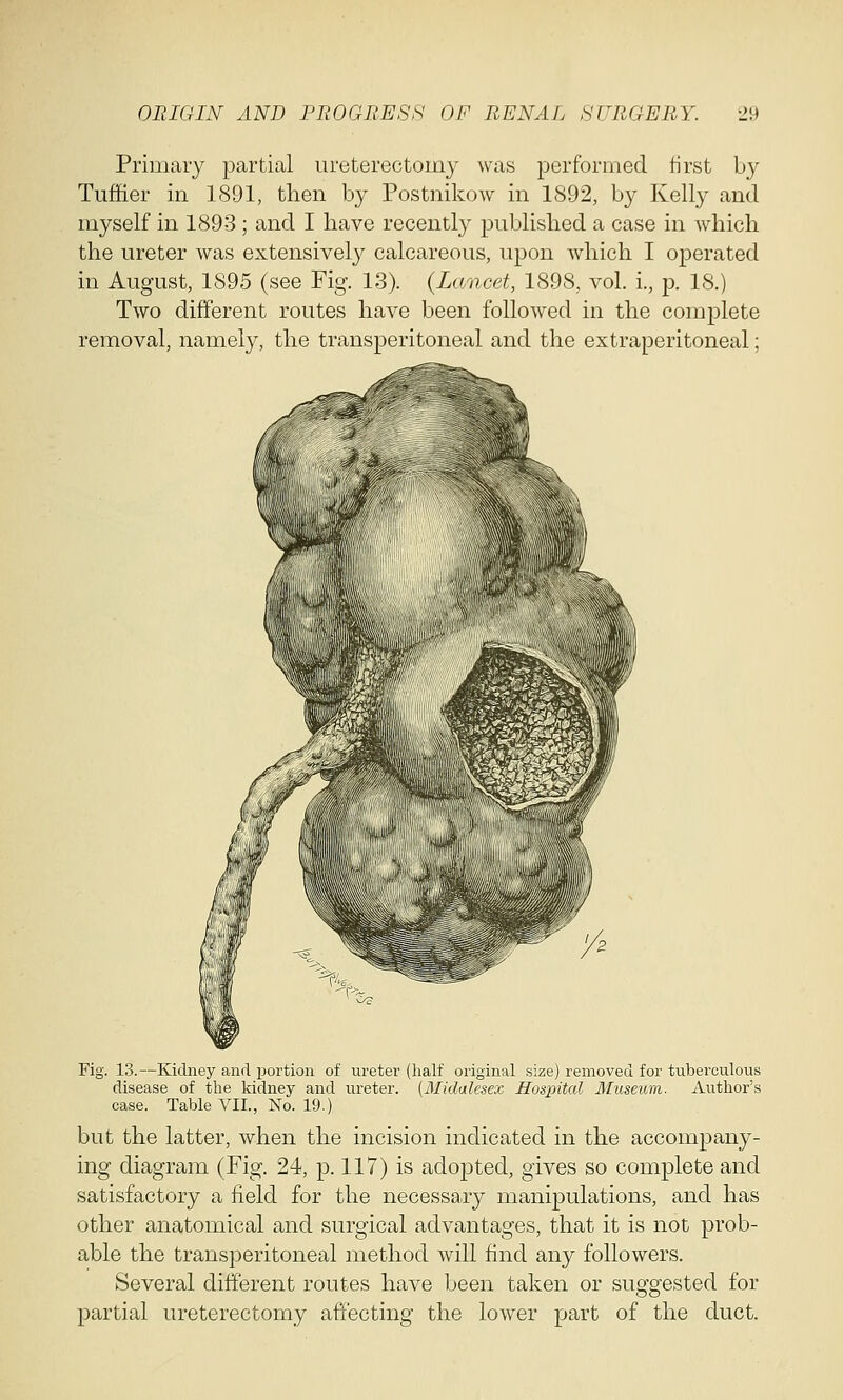 Primary partial ureterectomy was performed first by Tuffier in 1891, then by Postnikow in 1892, by Kelly and myself in 1893 ; and I have recently published a case in which the ureter was extensively calcareous, upon which I operated in August, 1895 (see Fig. 13). (Lancet, 1898, vol. i., p. 18.) Two different routes have been followed in the complete removal, namely, the transperitoneal and the extraperitoneal; Fig. 13.—Kidney and portion of ureter (half original size) removed for tuberculous disease of the kidney and ureter. (Middlesex Hospital Museum. Author's case. Table VII., No. 19.) but the latter, when the incision indicated in the accompany- ing diagram (Fig. 24, p. 117) is adopted, gives so complete and satisfactory a field for the necessary manipulations, and has other anatomical and surgical advantages, that it is not prob- able the transperitoneal method will find any followers. Several different routes have been taken or suggested for partial ureterectomy affecting the lower part of the duct.