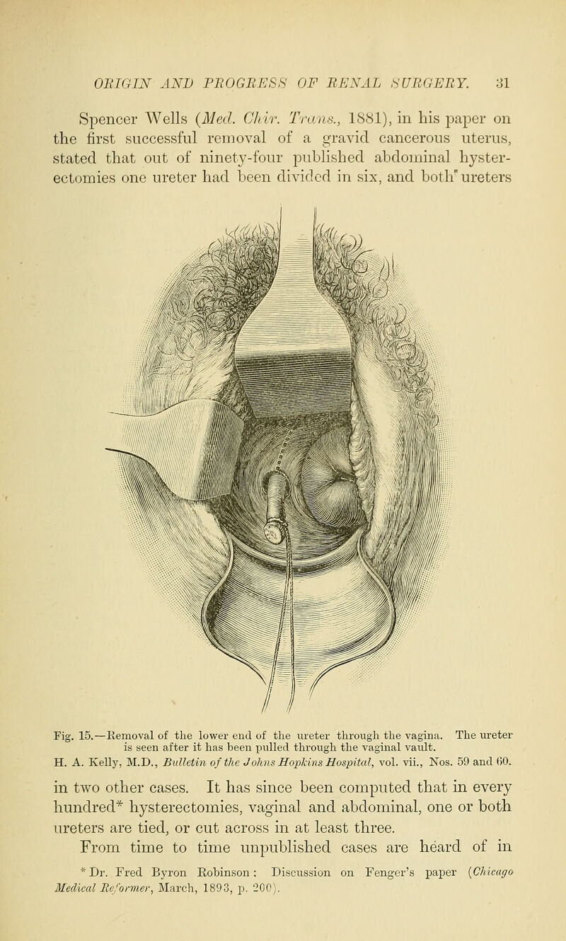 Spencer Wells (Med. Chir. Trans., 1881), in his paper on the first successful removal of a gravid cancerous uterus, stated that out of ninety-four published abdominal hyster- ectomies one ureter had been divided in six, and both ureters Fig. 15.—Removal of the lower end of the ureter through the vagina. The ureter is seen after it has been pulled through the vaginal vault. H. A. Kelly, M.D., Bulletin of the Johns Hopkins Hospital, vol. vii., Nos. 59 and 60. in two other cases. It has since been computed that in every hundred* hysterectomies, vaginal and abdominal, one or both ureters are tied, or cut across in at least three. From time to time unpublished cases are heard of in *Dr. Fred Byron Robinson; Discussion on Fenger's paper [Chicago Medical Reformer; March, 1893, p. 200).