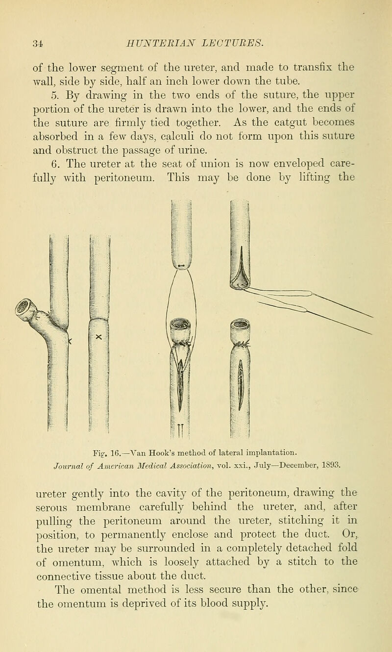 of the lower segment of the ureter, and made to transfix the wall, side by side, half an inch lower down the tube. 5. By drawing in the two ends of the suture, the upper portion of the ureter is drawn into the lower, and the ends of the suture are firmly tied together. As the catgut becomes absorbed in a few days, calculi do not form upon this suture and obstruct the passage of urine. 6. The ureter at the seat of union is now enveloped care- fully with peritoneum. This may be done by lifting the Fig. 16.—Van Hook's method of lateral implantation. Journal of American Medical Association, vol. xxi., July—December, 1893. ureter gently into the cavity of the peritoneum, drawing the serous membrane carefully behind the ureter, and, after pulling the peritoneum around the ureter, stitching it in position, to permanently enclose and protect the duct. Or, the ureter may be surrounded in a completely detached fold of omentum, Avhich is loosely attached by a stitch to the connective tissue about the duct. The omental method is less secure than the other, since the omentum is deprived of its blood supply.