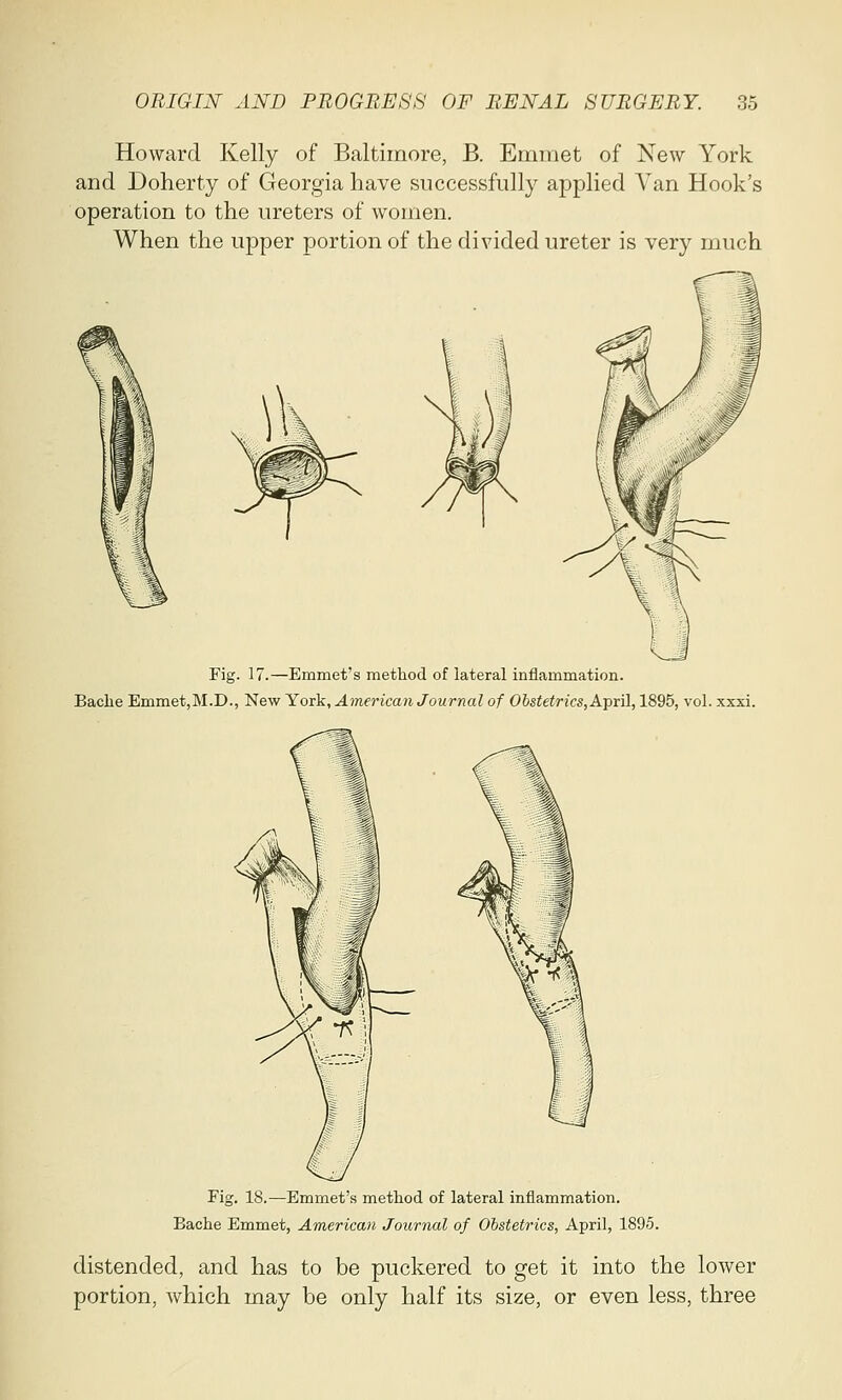 Howard Kelly of Baltimore, B. Emmet of New York and Doherty of Georgia have successfully applied Van Hook's operation to the ureters of women. When the upper portion of the divided ureter is very much Fig. 17.—Emmet's method of lateral inflammation. Bache Emmet,M.D., New York, American Journal of Obstetrics, April, 1895, vol. xxxi. Fig. 18.—Emmet's method of lateral inflammation. Bache Emmet, American Journal of Obstetrics, April, 1895. distended, and has to be puckered to get it into the lower portion, which may be only half its size, or even less, three