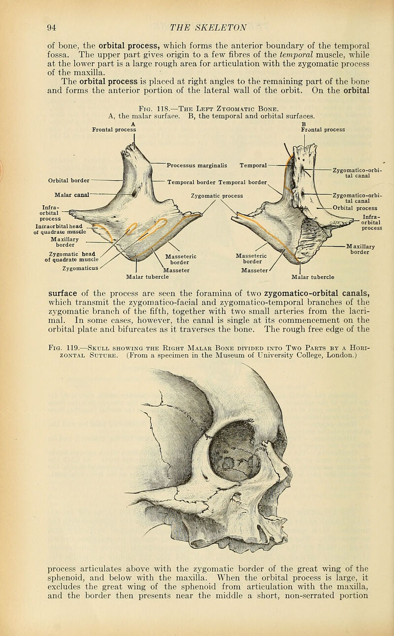 of bone, the orbital process, which forms the anterior boundary of the temporal fossa. The upper part gives origin to a few fibres of the temporal muscle, while at the lower part is a large rough area for articulation with the zygomatic process of the maxilla. The orbital process is placed at right angles to the remaining part of the bone and forms the anterior portion of the lateral wall of the orbit. On the orbital Fig. 118.—The Left Ztgoma.tic Bone. A, the malar surface. B, the temporal and orbital surfaces. Frontal process Frontal process Orbital border Malar canal Processus marginalis Temporal — Temporal border Temporal border Zygomatic process Infra- orbital process Intraorbital head ^'^ of quadrate muscle X-^ Maxillary border Zygomatic head of quadrate muscle Zygomaticus Masseter Malar tubercle Malar tubercle surface of the process are seen the foramina of two zygomatico-orbital canals, which transmit the zygomatico-facial and zygomatico-temporal branches of the zygomatic branch of the fifth, together with two small arteries from the lacri- mal. In some cases, however, the canal is single at its commencement on the orbital plate and bifurcates as it traverses the bone. The rough free edge of the Fig. 119.—Skull showing the Right Malar Bone DrviDED into Two Parts by a Hori- zontal Suture. (From a specimen in the Museum of University College, London.) process articulates above with the zygomatic border of the great wing of the sphenoid, and below with the maxilla. When the orbital process is large, it excludes the great wing of the sphenoid from articulation with the maxilla, and the border then presents near the middle a short, non-serrated portion