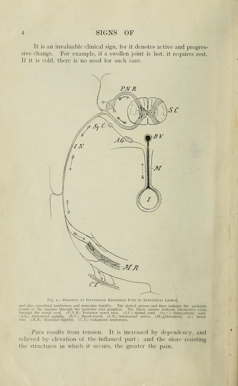 It is an invaluable clinical sign, for it denotes active and progres- sive change. For example, if a swollen joint is hot, it requires rest. If it is cold, there is no need for such care. Fig. I.—DiAGRAji TO Illustrate Referred Pain in Intestinal I,ESio>i, and also sunerficial tenderness and muscular rigidity. The dotted arrows and lines indicate the probable course of the impulse through the posterior root ganglion. The black arrows indicate alternative route through the sninal cord. {I'.N.R.) Posterior nerve root. (.S.C.) Spinal cord. (Sy.C.) Sympathetic cord. (A.G.) -Vbdominal ganglia. (B.V.) Blood-vessel. (I.N.) Intercostal nerve. {.l/.)^JIesentery. (/.) Intes- tine. (M.R.) Muscular rigidity. (C.T.) Cutaneous tenderness. Pain results Ircjin tension. It is increased by dependency, and relieved by elevation of the inflamed part; and the more resisting the structures in which it occurs, the greater the pain.