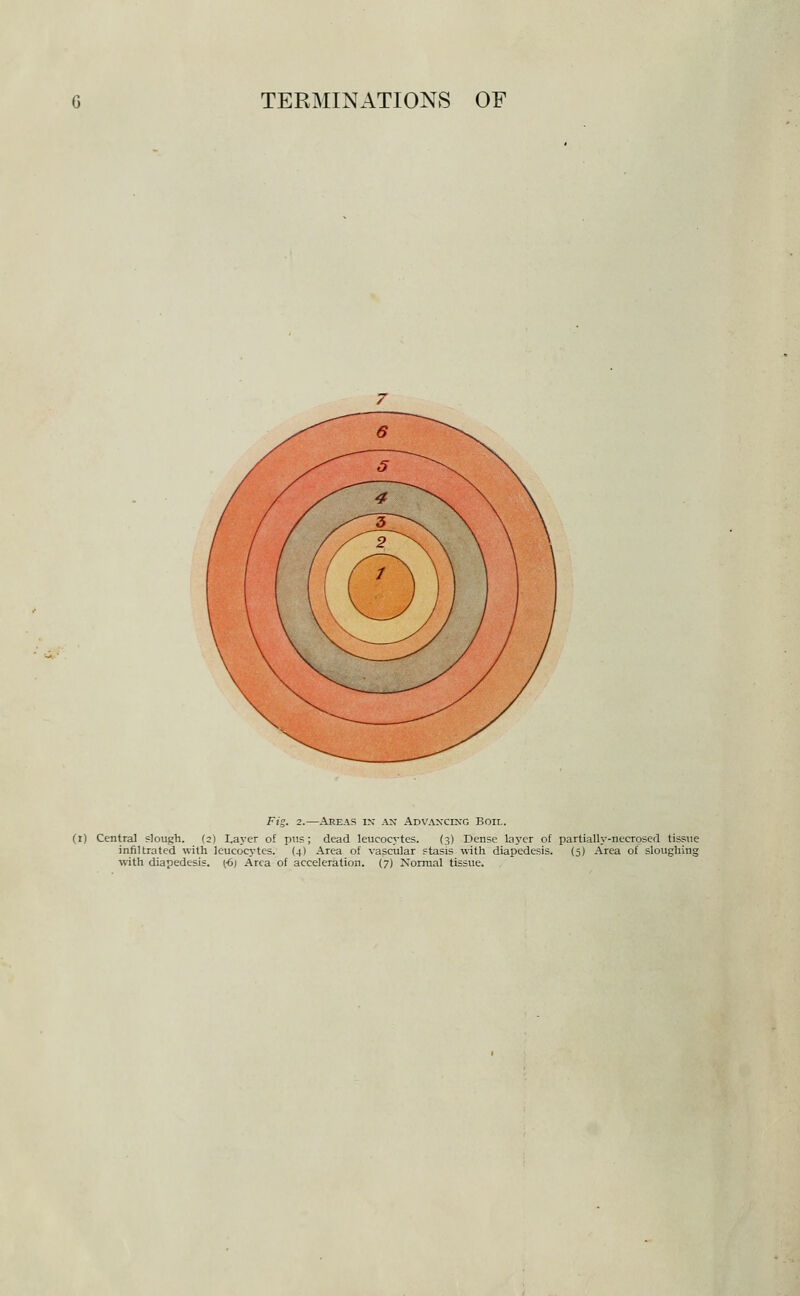 Fig. 2.—Areas in an Advancing Boir.. (t) Central slough. (2) Layer of piis; dead leucocytes. (3) Dense layer of partially-necrosed tissue infiltrated with leucocytes. (4) Area of vascular stasis with diapedesis. (5) Area of sloughing with diapedesis. (-6) Area of acceleration. (7) Xorraal tissue.