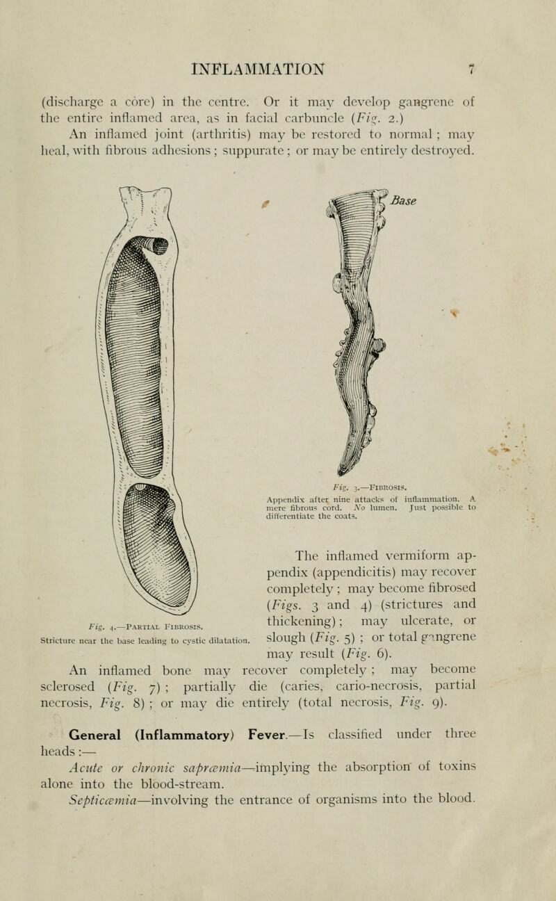 (discharge a core) in the centre. Or it may develop gangrene of the entire inflamed area, as in facial carbuncle {Fis;. 2.) An inflamed joint (arthritis) may be restored to normal ; ma}^ heal, with fibrous adhesions; suppurate; or may be entireh^ destroyed. Base Fig. ^.—Partial 1'ibrosis. Stricture near the base leading to cvstic dilatation. Fig. 3.—Fibrosis. Appendix after nine attacks of inflammation. .A. mere fibrous cord. Xo lumen. Just possible to differentiate the coats. The inflamed vermiform ap- pendix (appendicitis) may recover completely ; may become fibrosed {Figs. 3 and 4) (strictures and thickening); may ulcerate, or slough {Fig. 5) ; or total g-^.ngrene may result {Fig. 6). An inflamed bone may recover completely ; may become sclerosed {Fig. 7) ; partially die (caries, cario-necrosis, partial necrosis, Fig. 8) ; or may die entirel}^ (total necrosis, Fig. 9). General (Inflammatory) Fever.—Is classified under three heads :— Acute or chronic saprcnnia—^implying the absorption of toxins alone into the blood-stream. Septiccemia—involving the entrance of organisms into the blood.