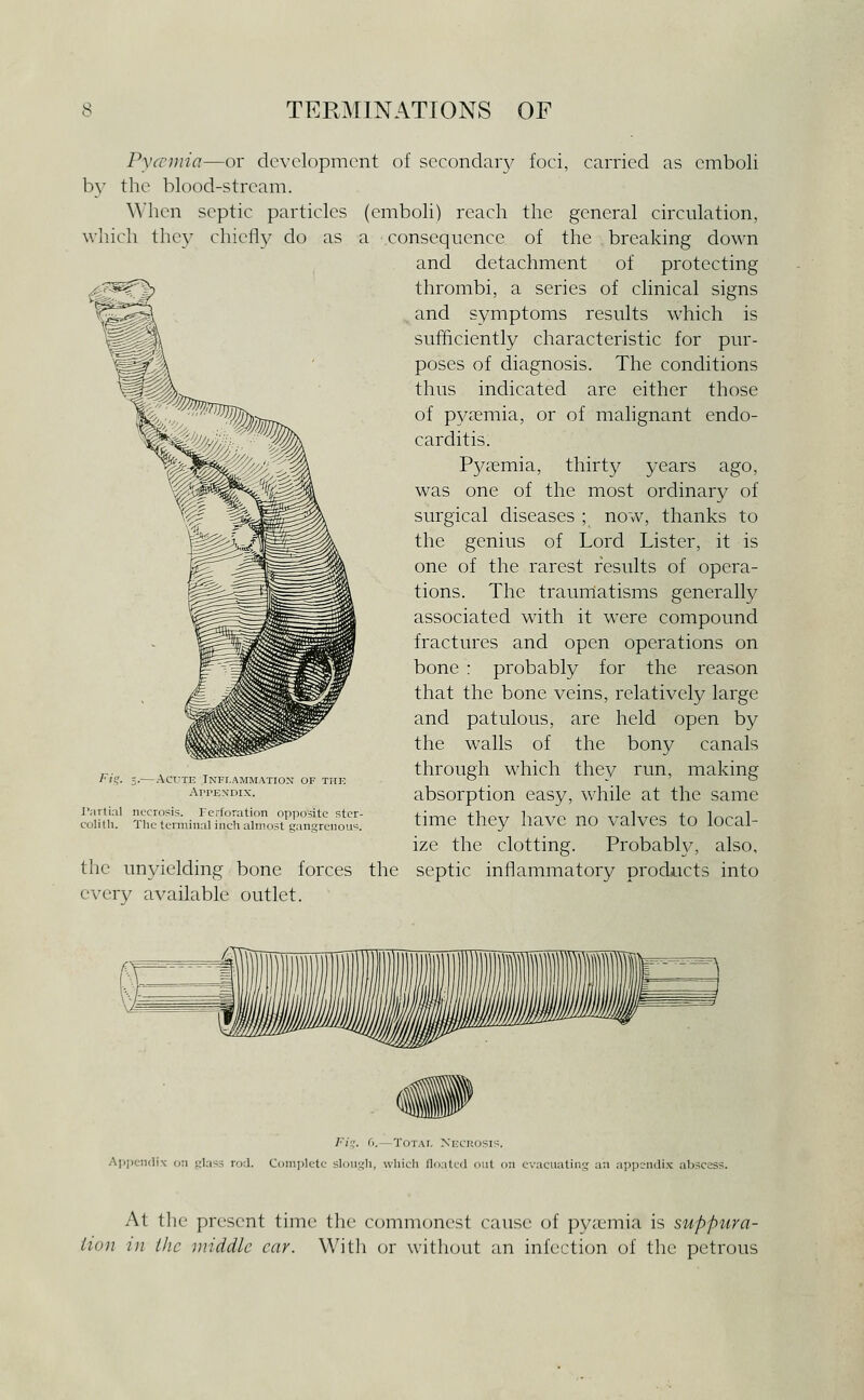 Pycrmia—or development of secondaiy foci, carried as emboli by the blood-stream. When septic particles (emboli) reach the general circulation, which they chiefly do as a consequence of the . breaking down and detachment of protecting thrombi, a series of clinical signs . and symptoms results which is sufficiently characteristic for pur- poses of diagnosis. The conditions thus indicated are either those of pyaemia, or of malignant endo- carditis. P573emia, thirty years ago, was one of the most ordinary of surgical diseases ; now, thanks to the genius of Lord Lister, it is one of the rarest results of opera- tions. The traurriatisms generally associated with it w^ere compound fractures and open operations on bone : probably for the reason that the bone veins, relatively large and patulous, are held open by the walls of the bony canals through which they run, making absorption easy, while at the same time they have no valves to local- ize the clotting. Probablv, also, the unyielding bone forces the septic inflammatory products into every available outlet. Fis;. Acute Inflammation of the Appendix. rartial necrosis, rerforation opposite stcr- colilh. The terminal inch almost gangrenou-^. /•■/;'. 6.—Total Necrosis. ApiK-ndix on jilass rod. Complete slough, which floated out on evacuating an appendix abscess. At the present time the commonest cause of pyaemia is suppura- tion in the middle car. With or without an infection of the petrous