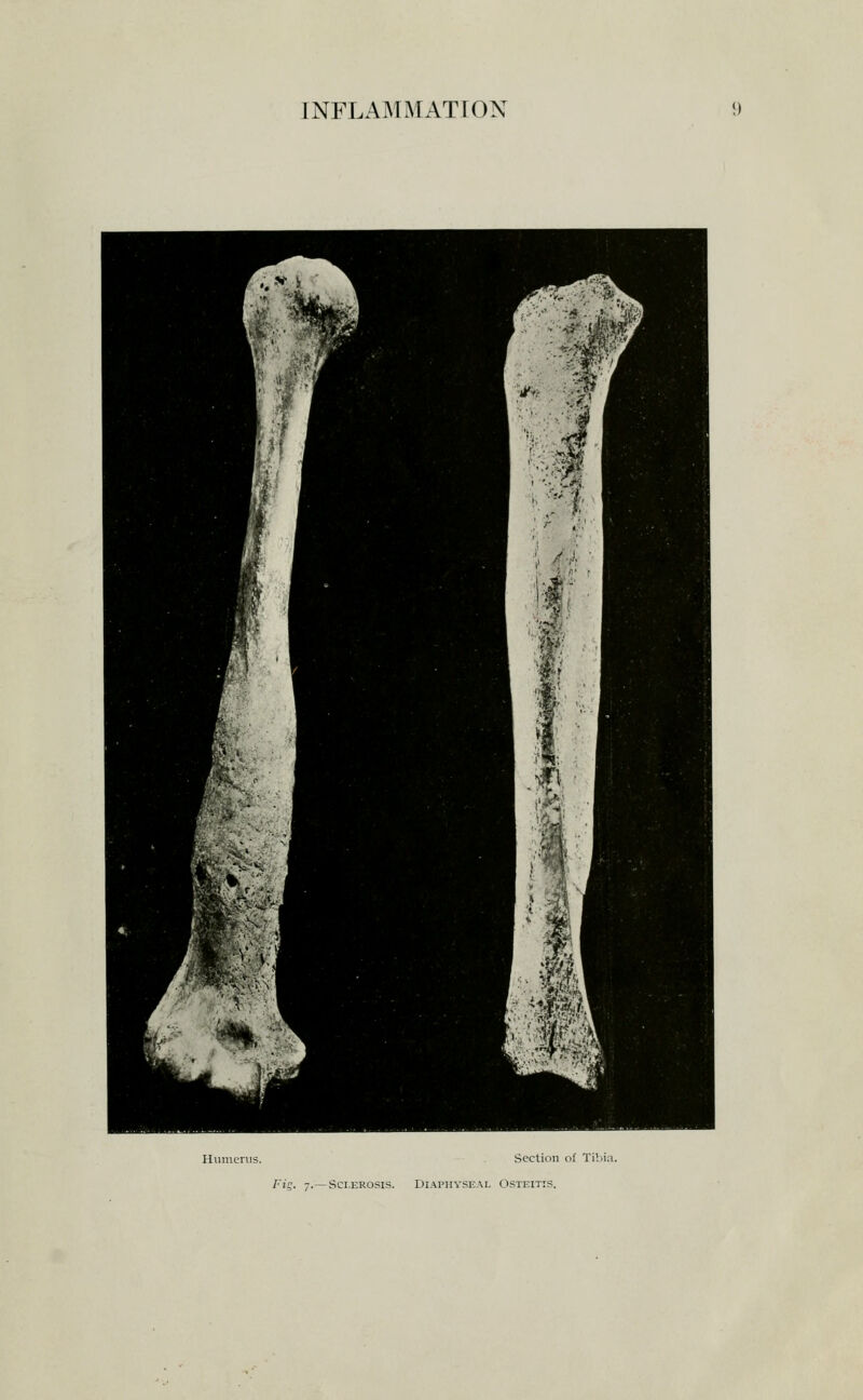 Humerus. Section of Tibia. Fig. 7.—Sclerosis. Di.\physe.^l Osteitis.