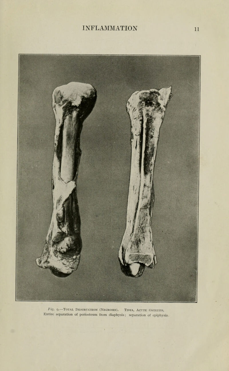 Fig. g.—Total Destrl-ciion (Necrosis). Tibia, Acute Osteitis. Entire separation of periosteum from diaph^-sis; separation of epiphysis.