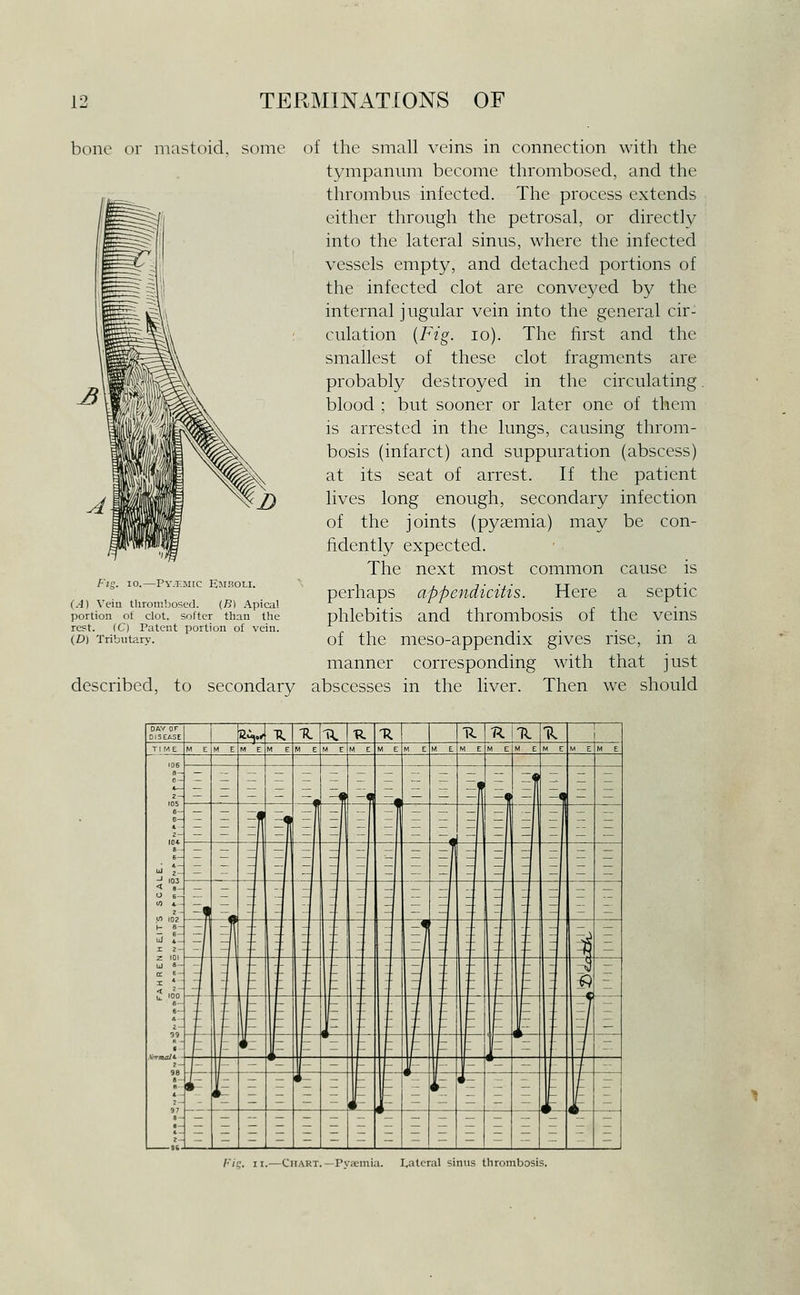 bone or mastoid, some of the small veins in connection with the tympanum become thrombosed, and the thrombus infected. The process extends either through the petrosal, or directly into the lateral sinus, where the infected vessels empty, and detached portions of the infected clot are conveyed by the internal jugular vein into the general cir- culation [Fig. lo). The first and the smallest of these clot fragments are probably destroyed in the circulating blood ; but sooner or later one of them is arrested in the lungs, causing throm- bosis (infarct) and suppuration (abscess) at its seat of arrest. If the patient lives long enough, secondary infection of the joints (pyaemia) may be con- fidently expected. The next most common cause is perhaps appendicitis. Here a septic phlebitis and thrombosis of the veins of the meso-appendix gives rise, in a manner corresponding with that just described, to secondary abscesses in the liver. Then we should Fig. 10.—Pyj.mic Emboli. C-1) Vein thrombosed. (B) Apica! portion ot clot, softer than the rest. (C) Patent portion of vein. (D) Tributary. Chart.—Pyaemia. I,atcral sinns thrombosis.