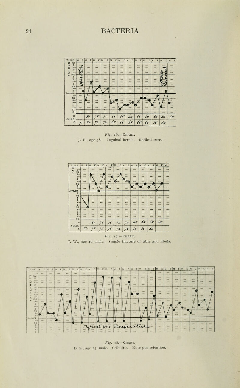 Fig. 16.—Chart. J. B., age 38. Inguinal hernia. Radical cure. TIME M eIm EJM eIm eIm e M E M E M E M E M E M 2 100 99 9S B- 2- 97 A — 1- 96- M PULSE E — - - - - - - - - = h. ^ f ^ s E - _^ ^ H- - y^ «^ \A / j; - - •_ - - - - - i - - ^ E E z E E E E _ E E 5 z E ~ E E E E E E go 7' /^ /■ / /r /r /r /r 8^1. jr r /^ 7^ 7' /f /r /r Fz?. 17.—Chart. T. W., age 40, male. Simple fracture of tibia and fibula. E jM E M E 'M E JM EJM EM E 'm E W E 1m E |M E I M E|M E W E|M EM E_M EM EIM EM EM ElM E Fi?. 18.—Chart. D. S., age 25, male. Cellulitis. Note pus retention.