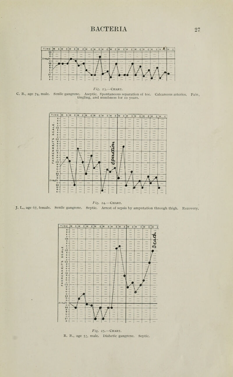 TIME |m e|m e|m e|m eIm EiM E [m E M e|m e|m e[m e;m e M EjM * M eI M-rmalt.- l- 98 »- 97 — - z - - f: - ~ :: I z T ;: - - • i''^ - - -A - '» — - - - '- /^ ~ 5 ^ ^ t u A^^ ^ V^ \^A - - - — - «- - «_ ^- K'1 - Fig. 23.—Chart. C. B., age 74, male. Senile gangrene. Aseptic. Spontaneous separation of toe. Calcareous arteries. Pain, tingling, and numbness for 10 years. Fig. 24.—Ch.\rt. J. I.., age 67, female. Senile gangrene. Septic. Arrest of sepsis by amputation through thigh. Recovery. Fig. 25.—Chart. R. R., age 53, male. Diabetic gangrene. Septic.