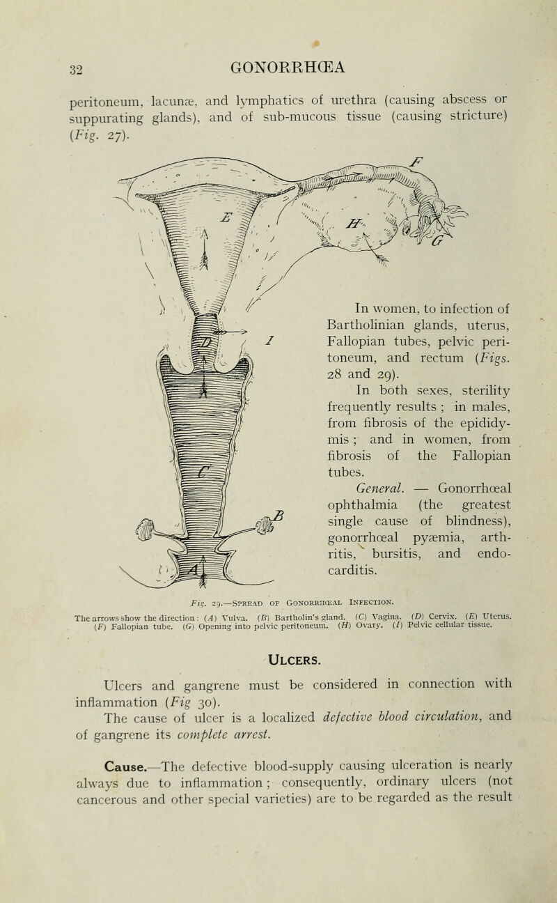 peritoneum, lacimne. and lymphatics of urethra (causing abscess or suppurating glands), and of sub-mucous tissue (causing stricture) {Fig. 27). In women, to infection of Bartholinian glands, uterus, Fallopian tubes, pelvic peri- toneum, and rectum {Figs. 28 and 29). In both sexes, sterility frequently results ; in males, from fibrosis of the epididy- mis ; and in women, from fibrosis of the Fallopian tubes. General. — Gonorrhoeal ophthalmia (the greatest single cause of blindness), gonorrhoeal pyaemia, arth- ritis, bursitis, and endo- carditis. Fig. 29.—Spread of Gonorrhceal Infection. The arrows show the direction: (/I) Vulva. (B) Bartholin's gland. (C) Vagina. (D) Cervix. (£) Uterus. (F) Fallopian tube. (G) Opening into pelvic peritoneum. (H) Ovar}-. (/) Pelvic cellular tissue. Ulcers. Ulcers and gangrene must be considered in connection with inflammation {Fig 30). The cause of ulcer is a localized defective blood circulation, and of gangrene its complete arrest. Cause.—The defective blood-supply causing ulceration is nearly always due to inflammation; consequently, ordinary ulcers (not cancerous and other special varieties) are to be regarded as the result