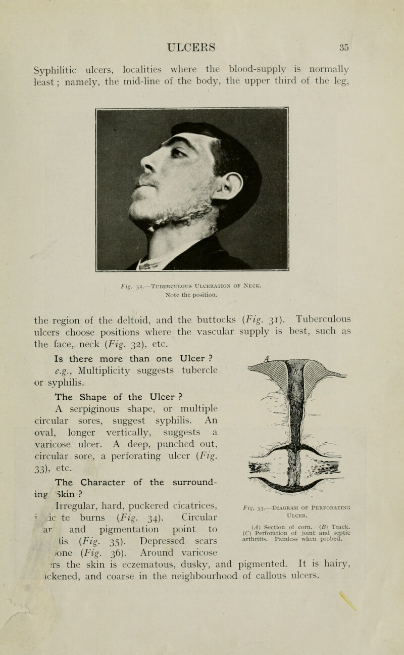 Syphilitic ulcers, localities where the blood-supply is normally least; namely, the mid-hne of the body, the upper third of the leg, Fig. 32.—Tuberculous Ulceration of Neck. Note the position. the region of the deltoid, and the buttocks {Fig. 31). Tuberculous ulcers choose positions where the vascular supply is best, such as the face, neck {Fig. 32), etc. Is there more than one Ulcer ? e.g., Multiplicity suggests tubercle or syphilis. The Shape of the Ulcer ? A serpiginous shape, or multiple circular sores, suggest syphilis. An oval, longer vertically, suggests a varicose ulcer. A deep, punched out, circular sore, a perforating ulcer {Fig. 33)' etc. The Character of the surround- ing Skin ? Irregular, hard, puckered cicatrices, i .ic te burns {Fig. 34). Circular ar and pigmentation point to lis {Fig. 35). Depressed scars ^one {Fig. 36). Around varicose ;rs the skin is eczematous, dusky, and pigmented. It is hairy, tokened, and coarse in the neighbourhood of callous ulcers. F;?. 33.—Diagram of Perforating Ulcer. (.-1) Section of corn. (B) Track. (C) Perforation of joint and septic arthritis. Painless when probed.