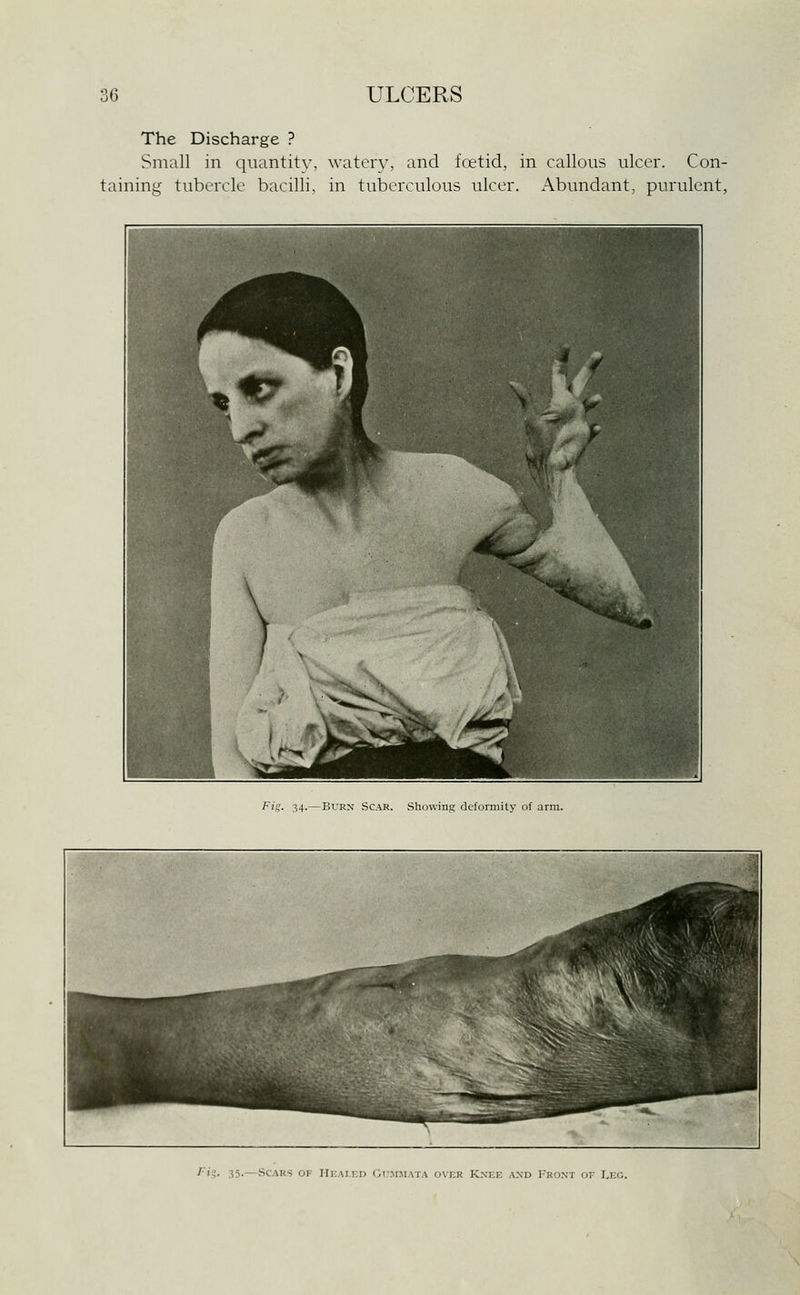 The Discharge ? Small in qiiantitv, watery, and foetid, in callous ulcer. Con- taining tubercle bacilli, in tuberculous ulcer. Abundant, purulent, Fis:. 34.—Burn Scar. Showing deformity of arm. ^i?- 35-—Scars of Heai.kd Gi-mmata over Knek axd 1'ront of I,eg.