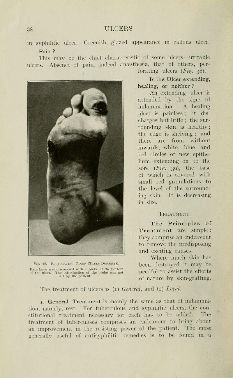 in syphilitic ulcer. Greenish, glazed appearance in callous ulcer. Pain ? This may be the chief characteristic of some ulcers—irritable ulcers. x\bsence of pain, indeed anaesthesia, that of others, per- forating ulcers {Fig. 38). Is the Ulcer extending, healing, or neither ? An extending ulcer is attended by the signs of inflammation. A healing ulcer is painless ; it dis- charges but little ; the sur- rounding skin is healthy; the edge is shelving ; and there are from without inwards, white, blue, and red circles of new epithe- lium extending on to the sore {Fig. 39), the base of which is covered with small red granulations to the level of the surround- ing skin. It is decreasing in size. Treatment. The Principles of Treatment are simple : they comprise an endeavour to remove the predisposing and exciting causes. Where much skin has been destroyed it may be needful to assist the efforts of nature by skin-grafting. Fig. 38.—Perforating Ulcer'(Tabes Dorsaiis). Bare bone was discovered with a probe at the bottom of the ulcer. The introduction of the probe was not felt by the patient. The treatment of ulcers is (i) General, and (2) Local. I. General Treatment is mainly the same as that of inflamma- tion, namely, rest. For tuberculous and syphilitic ulcers, the con- stitutional treatment necessary for each has to be added. The treatment of tuberculosis comprises an endeavour to bring about an improvement in the resisting power of the patient. The most generally useful of antisyphilitic remedies is to be found in a